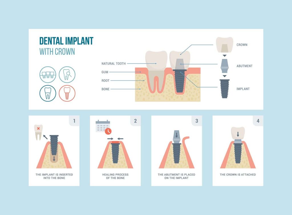 dental implant procedure