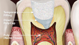 direct pulp capping