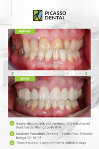 smile makeover without braces