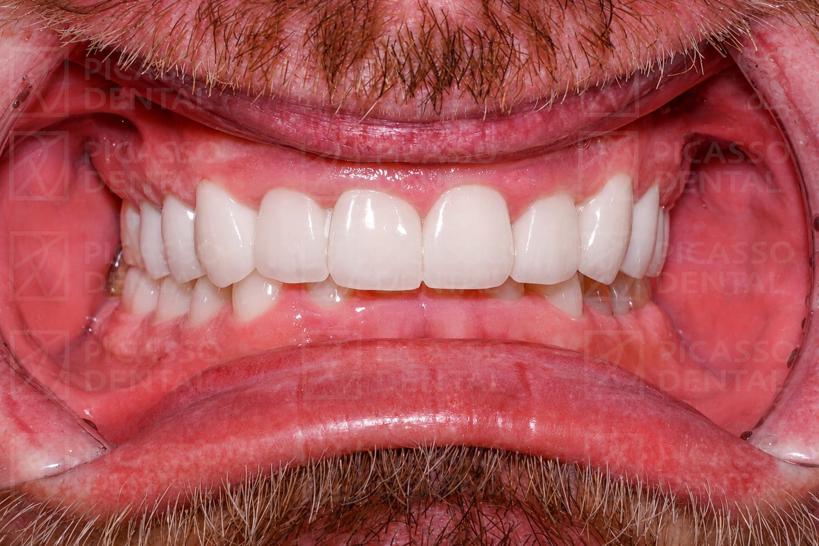 After: 20 LAVA 3M porcelain veneers, upper and lower jaw