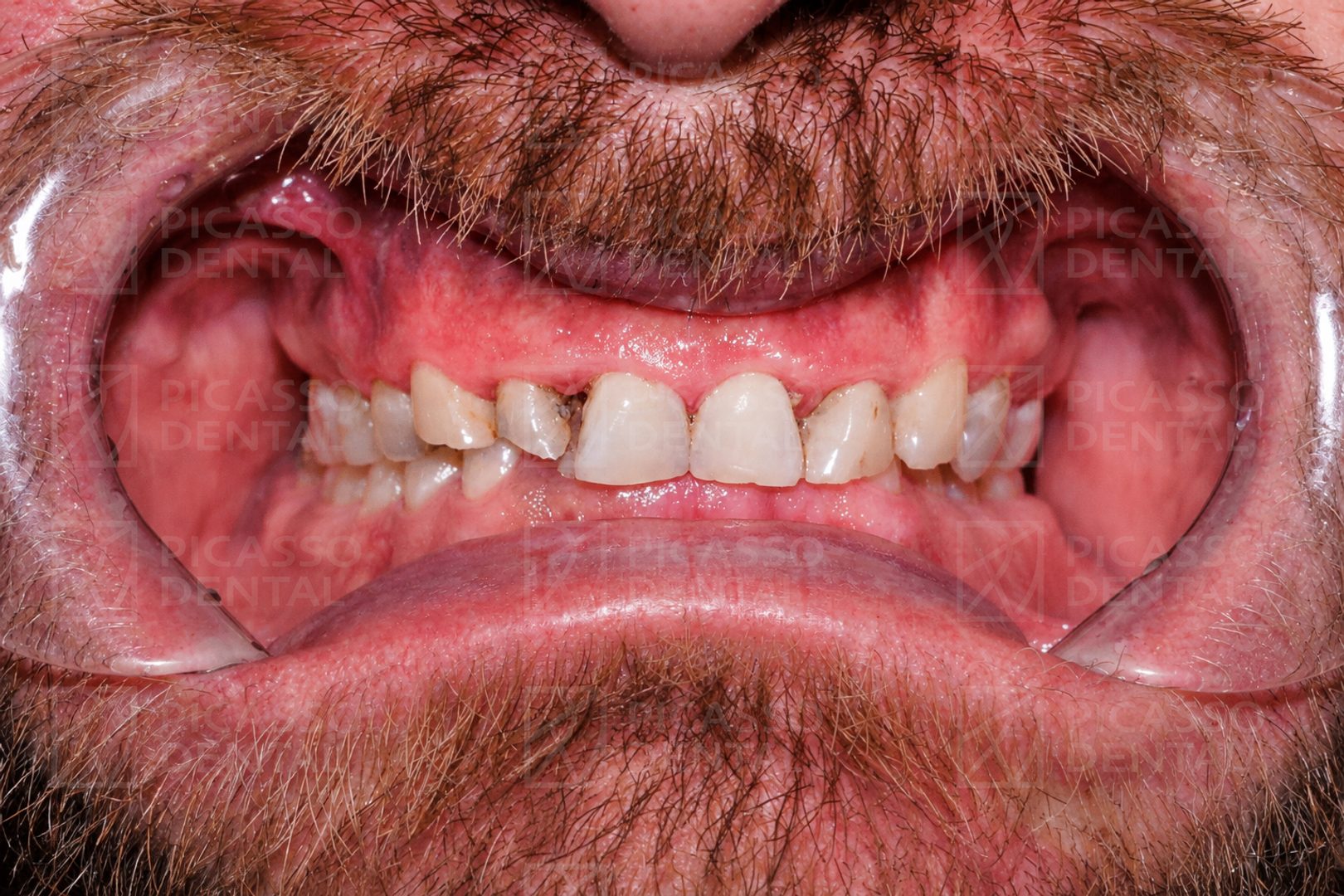 Before: misaligned and discoloured teeth prior to 20-veneer treatment
