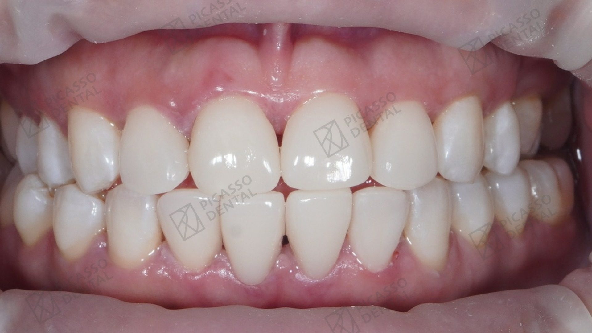 After: composite veneers across upper and lower anterior teeth combined with Zoom whitening, Picasso Dental Da Nang