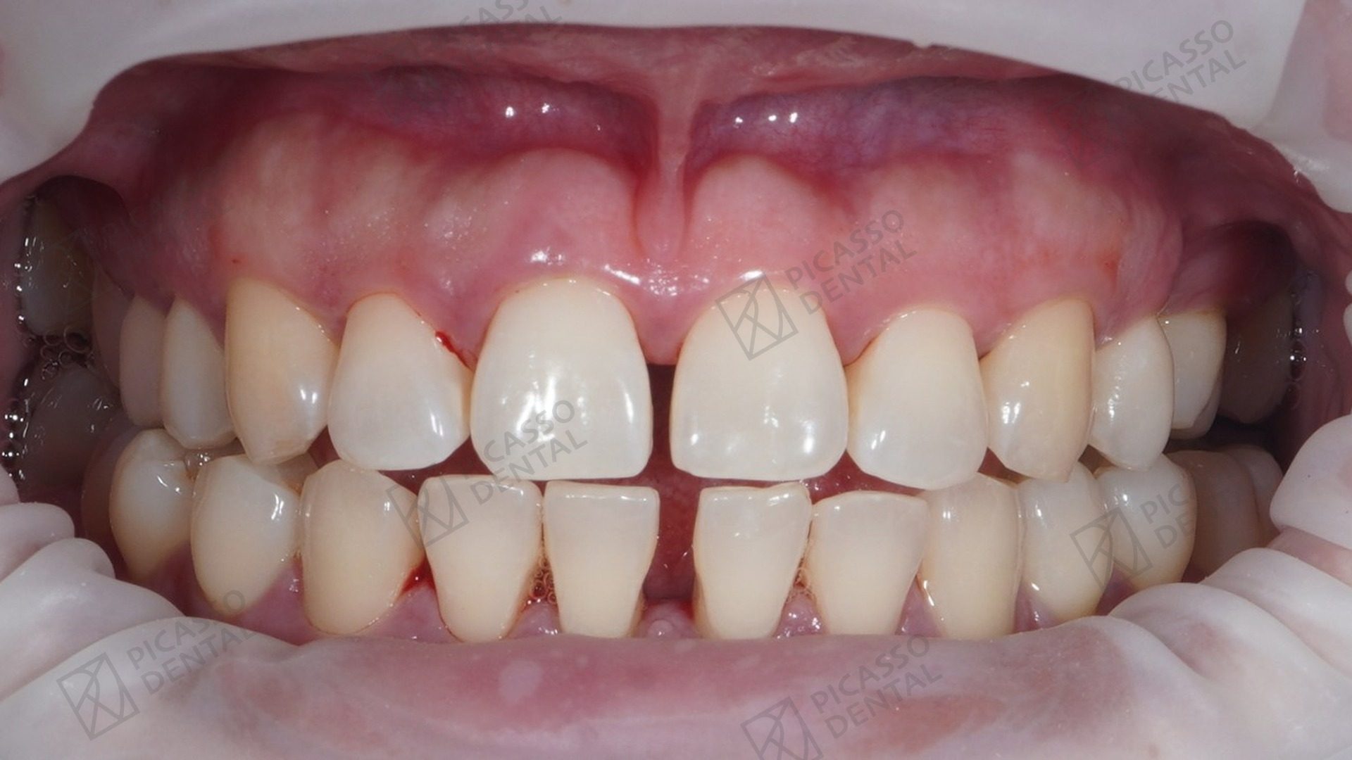 Before: stained and gappy lower and upper teeth prior to composite veneers and whitening