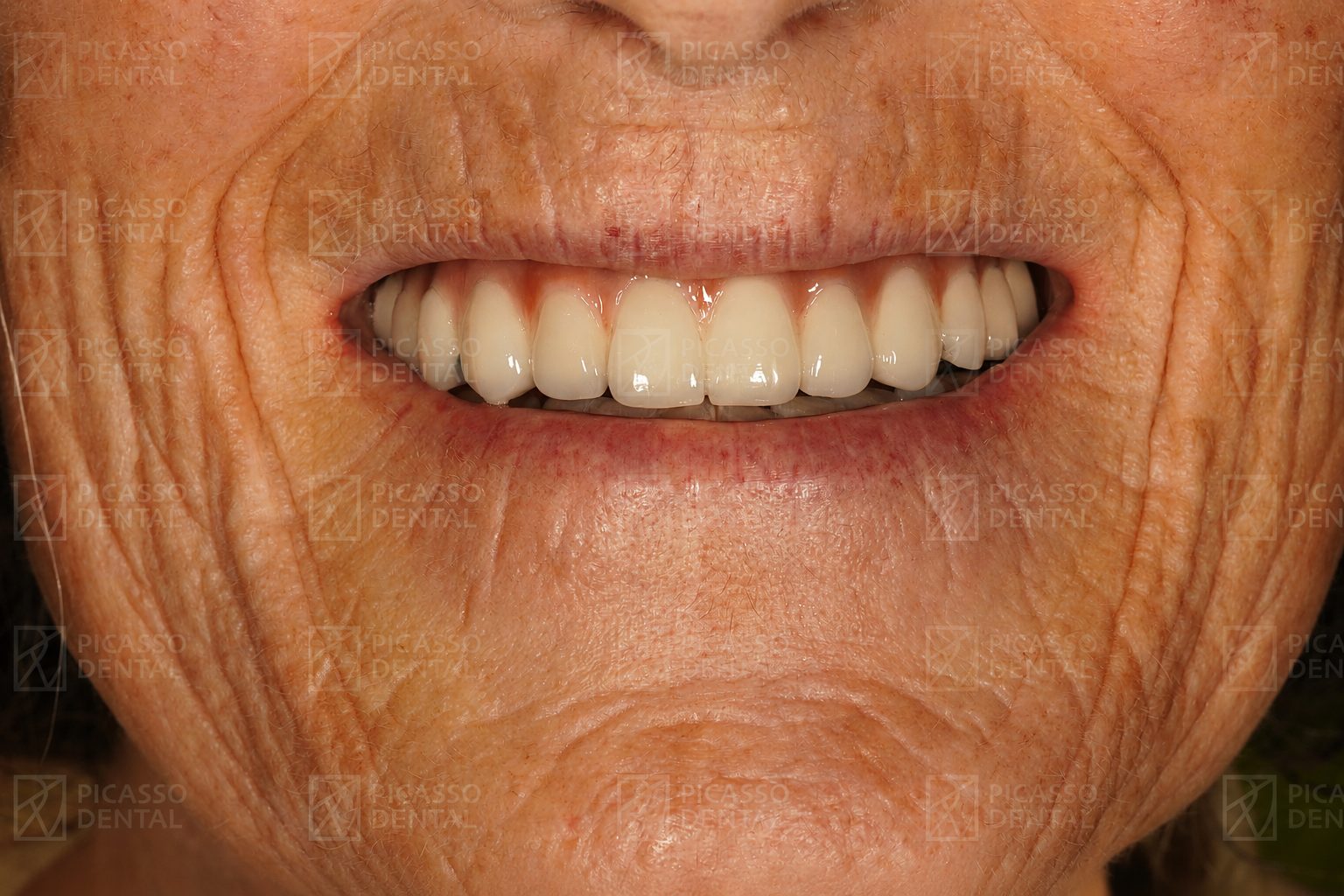 After treatment at Picasso Dental