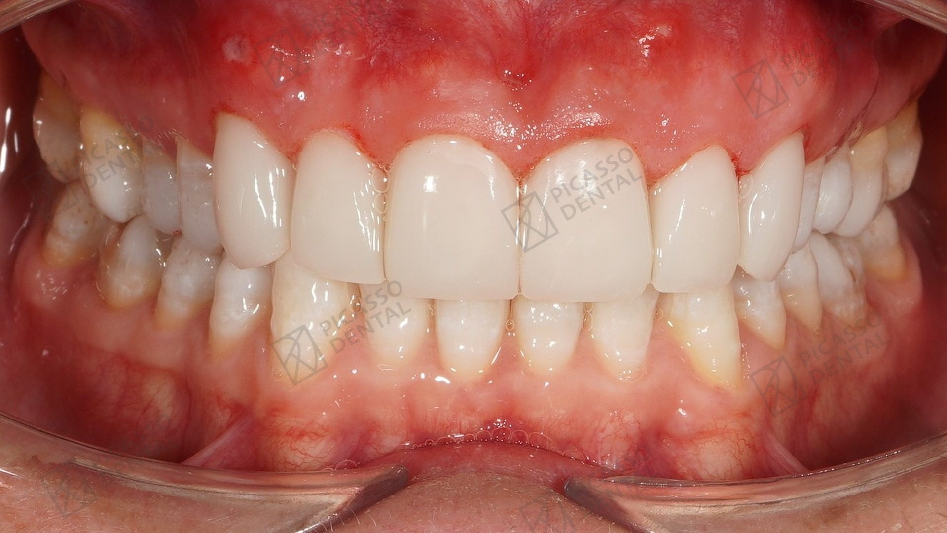 After: 6 composite veneers on upper anteriors with Zoom whitening, Picasso Dental Da Nang