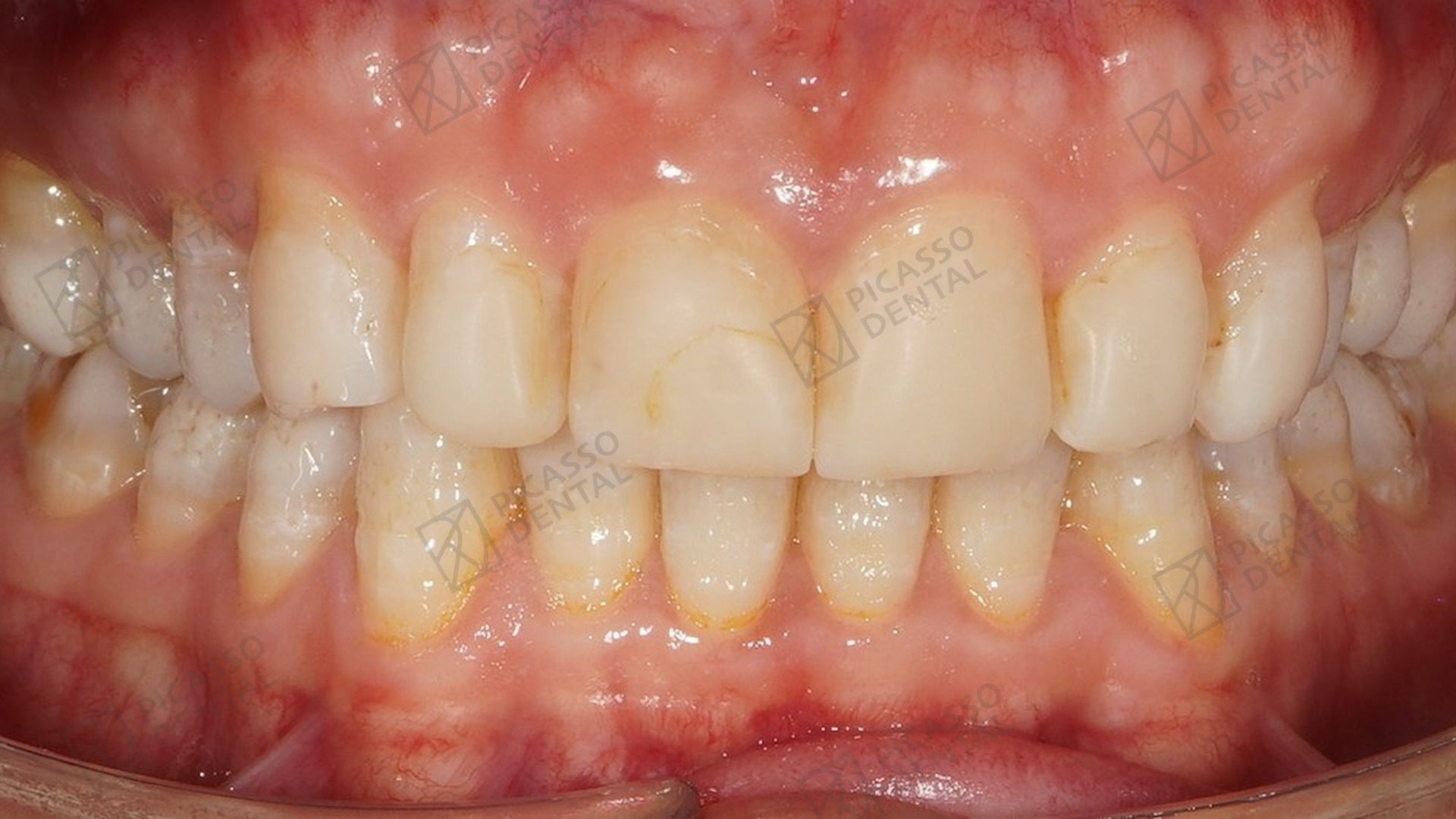 Before: misshapen and stained upper anterior teeth with rotated lateral incisor