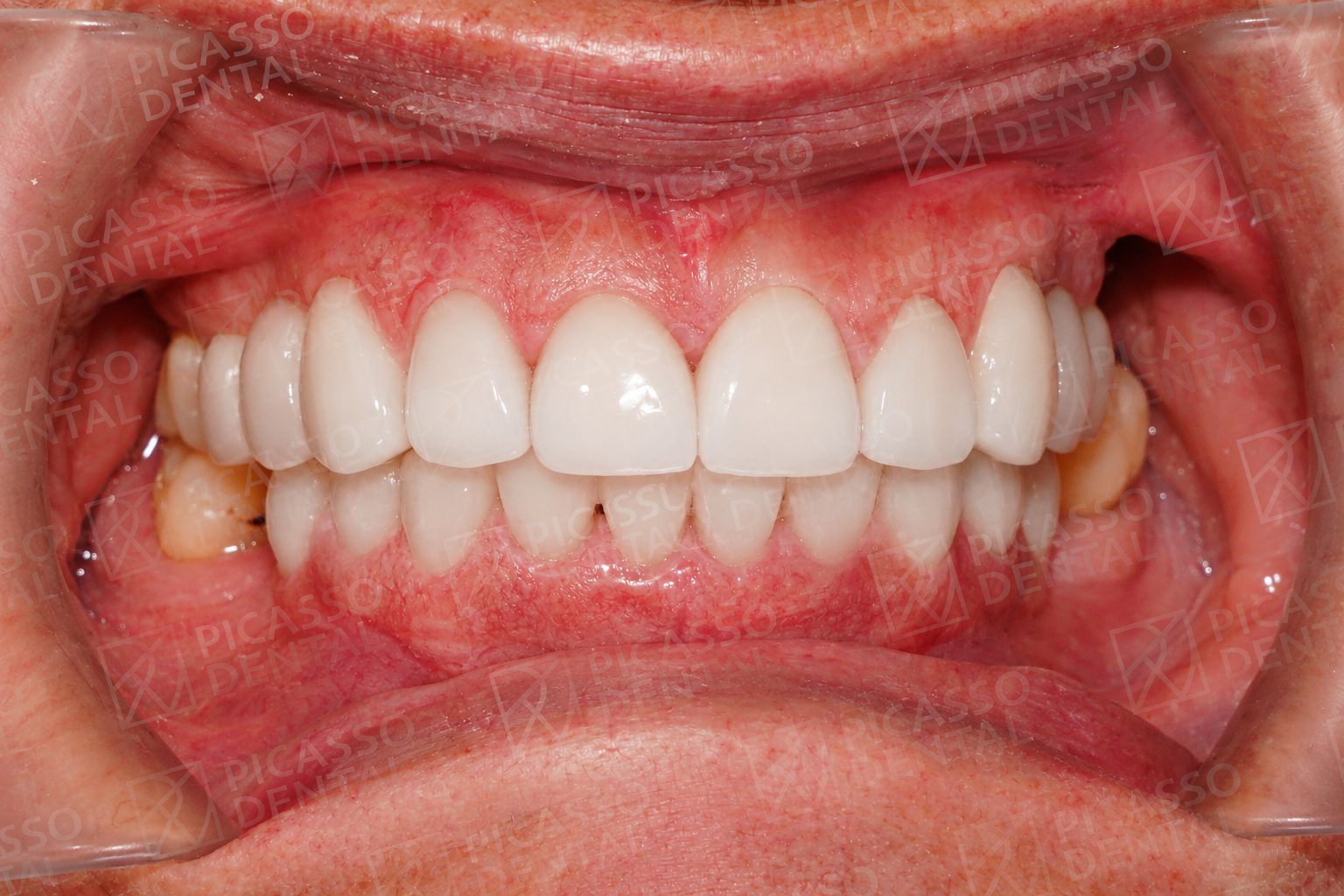 After: 11 LAVA crowns upper jaw and 9 Lisi veneers lower jaw, Picasso Dental HCMC