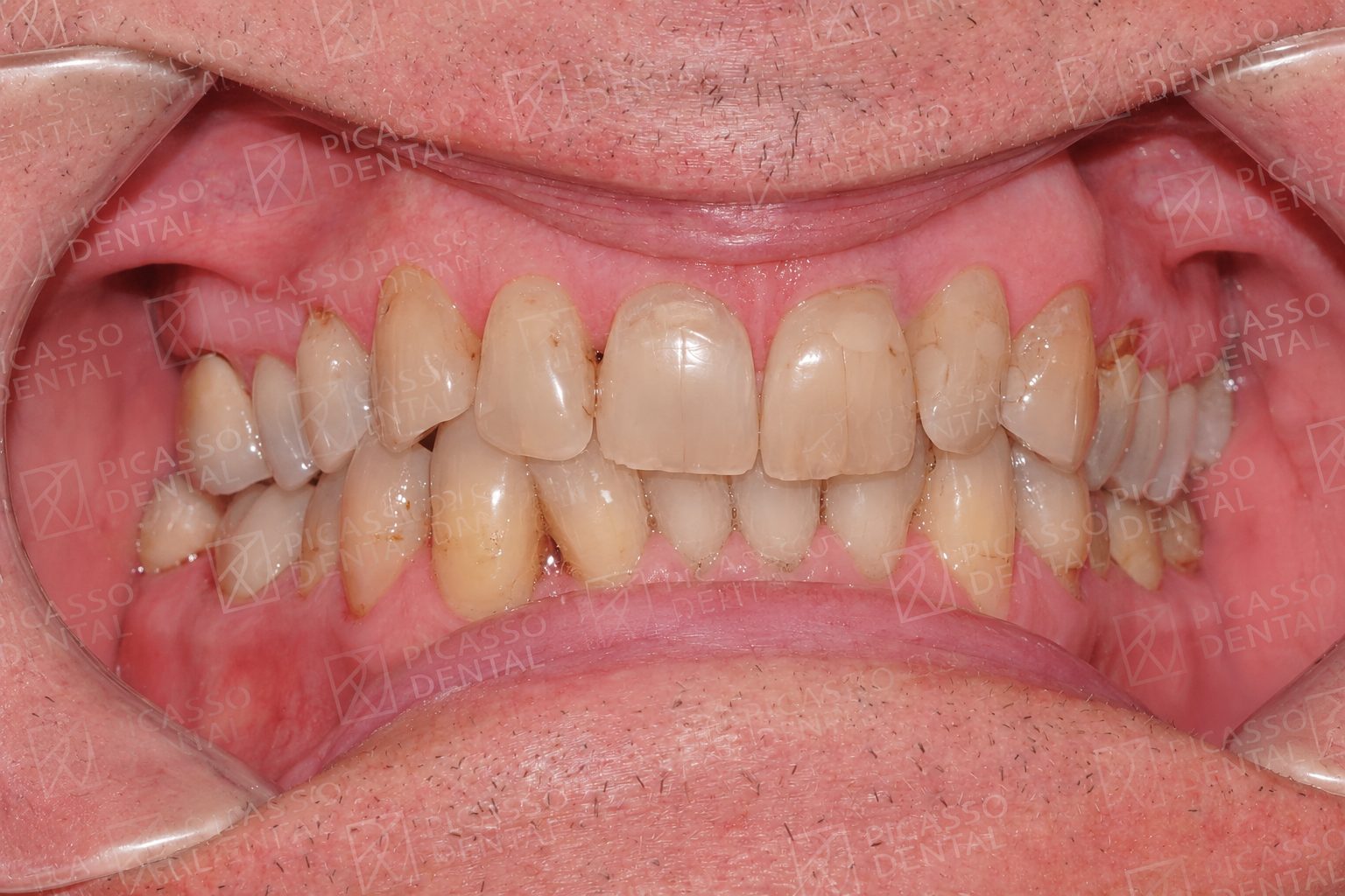 Before cosmetic treatment at Picasso Dental