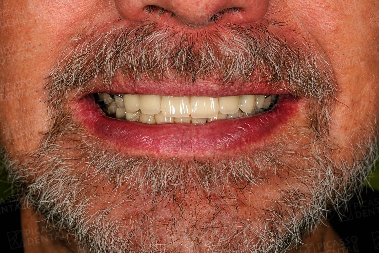 After smile restoration at Picasso Dental