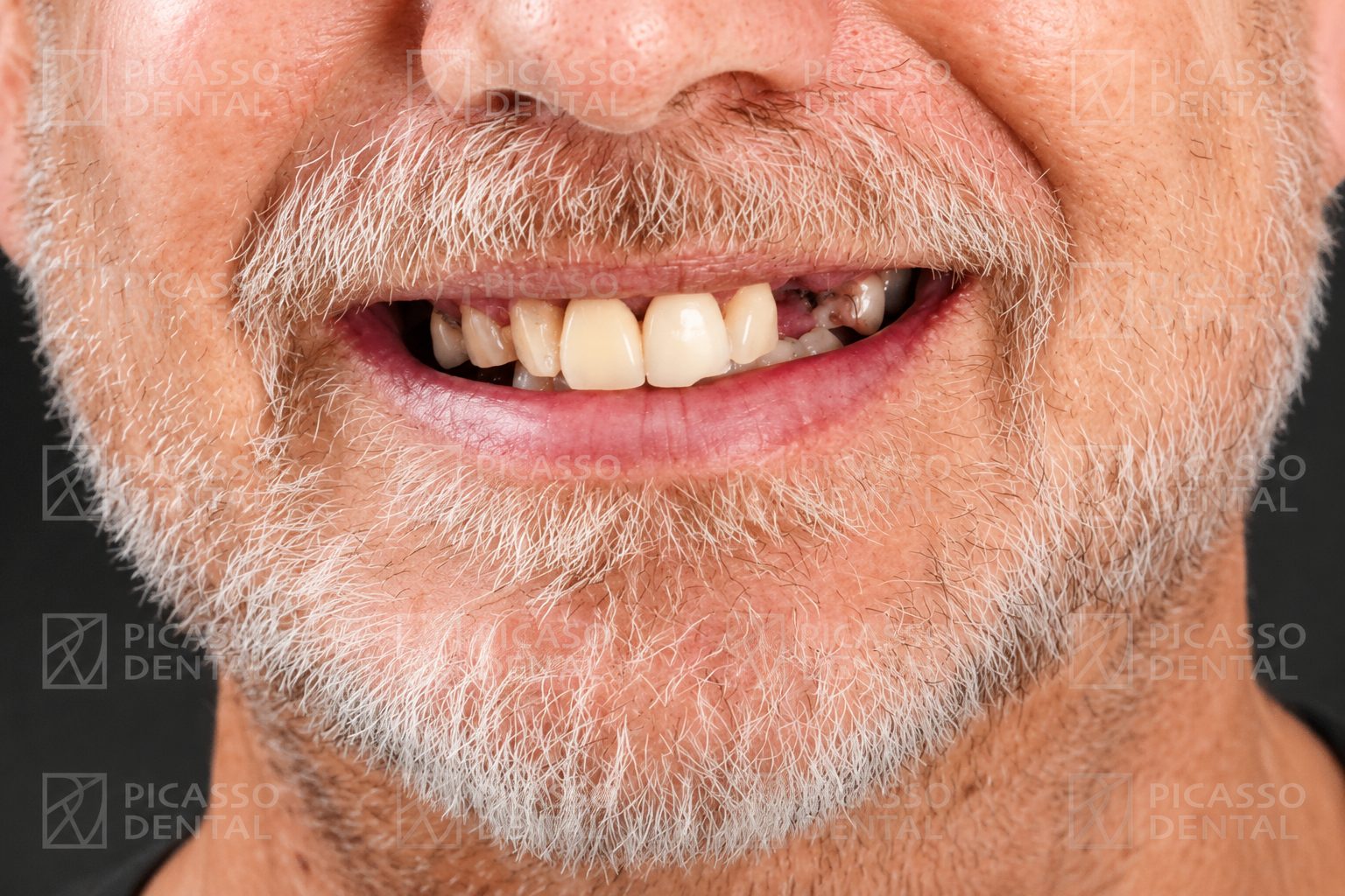 Before smile restoration at Picasso Dental