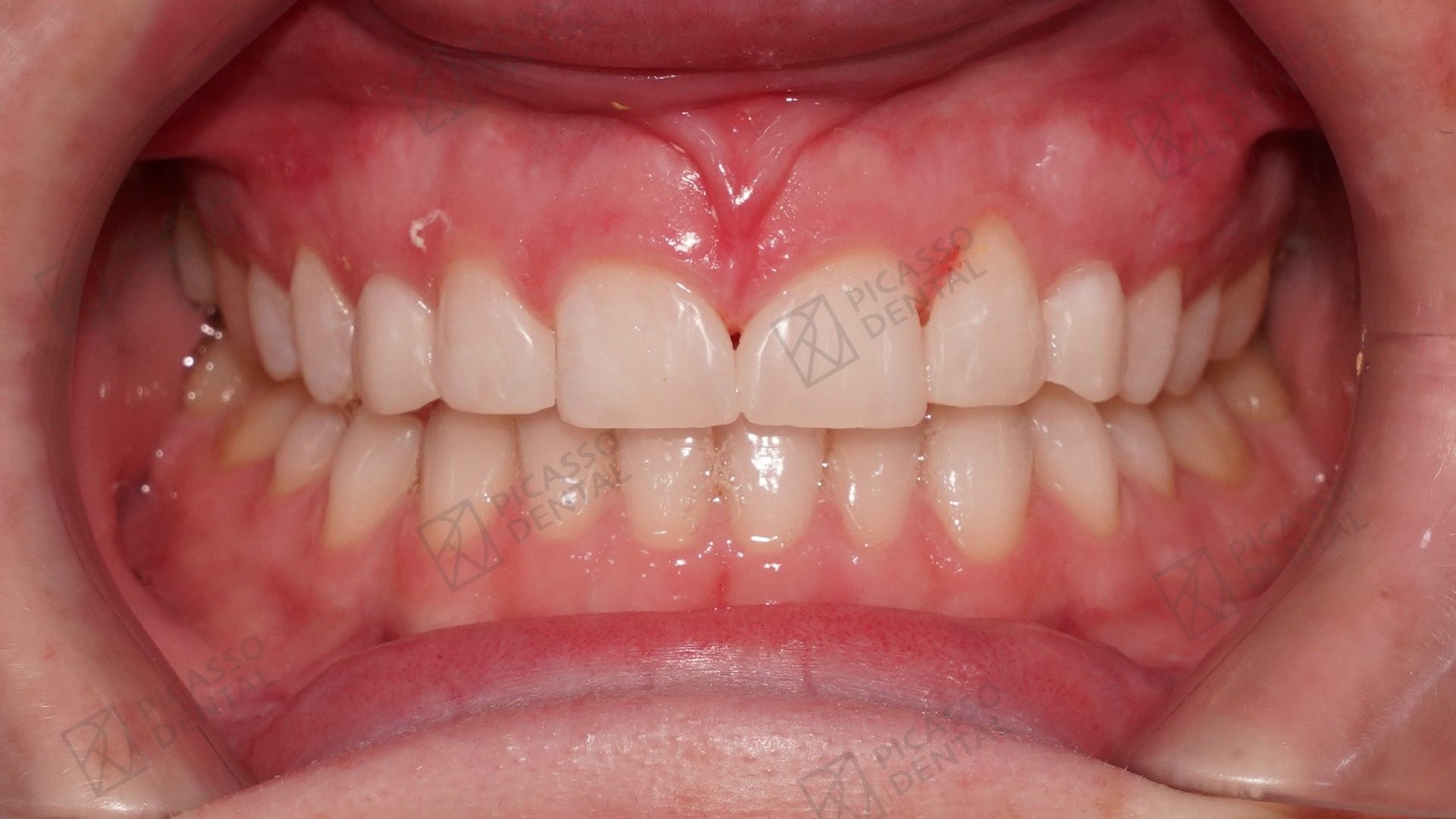 After: composite veneers and cosmetic Class IV restorations on upper anteriors, Picasso Dental Thao Dien