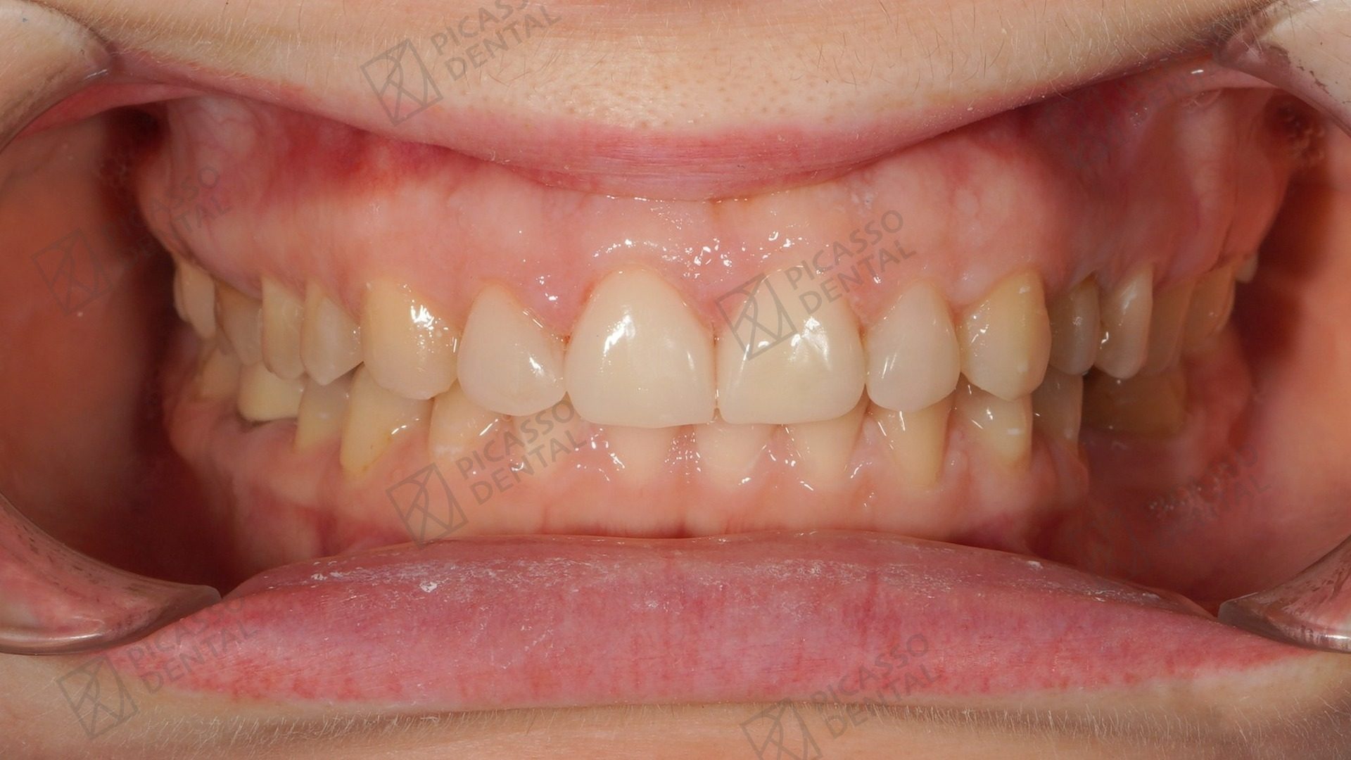 After: layered composite veneers on upper anteriors with brighter, even edges, Picasso Dental Da Nang