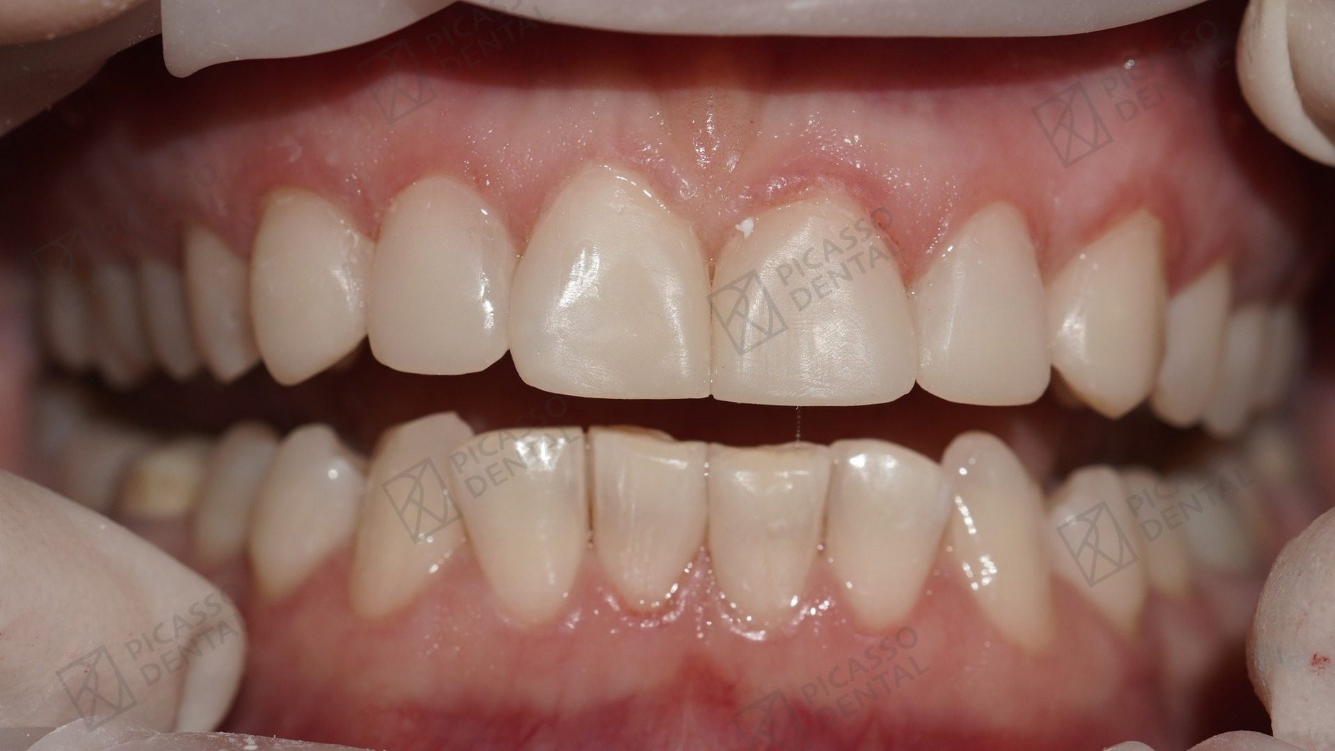 After: 6 upper composite veneers with diastema closure and reshaped lateral incisor, Picasso Dental Hanoi Westlake