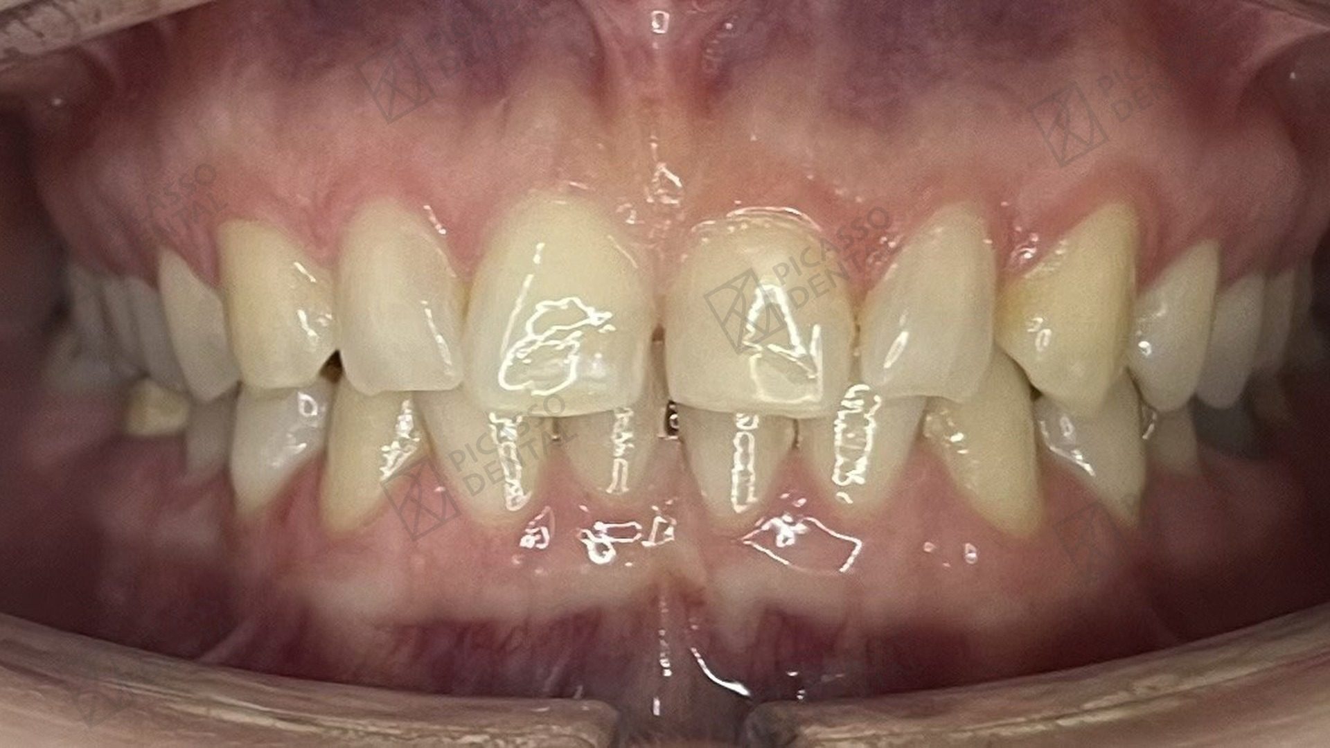 Before: peg-shaped lateral incisor and spacing across upper anterior teeth prior to composite veneer treatment