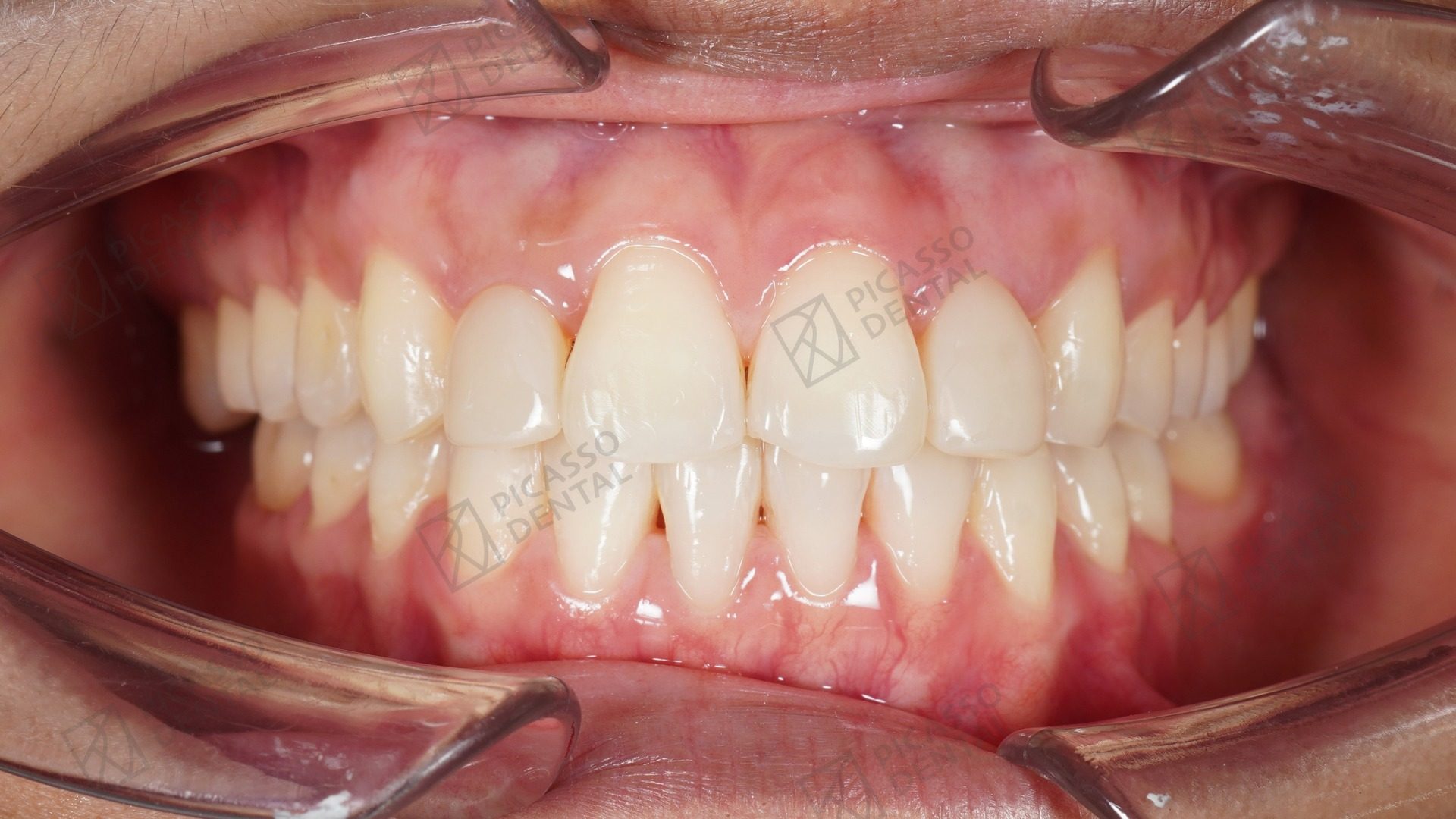 After: composite veneers on upper lateral incisors finishing an orthodontic case, Picasso Dental Hanoi Old Quarter