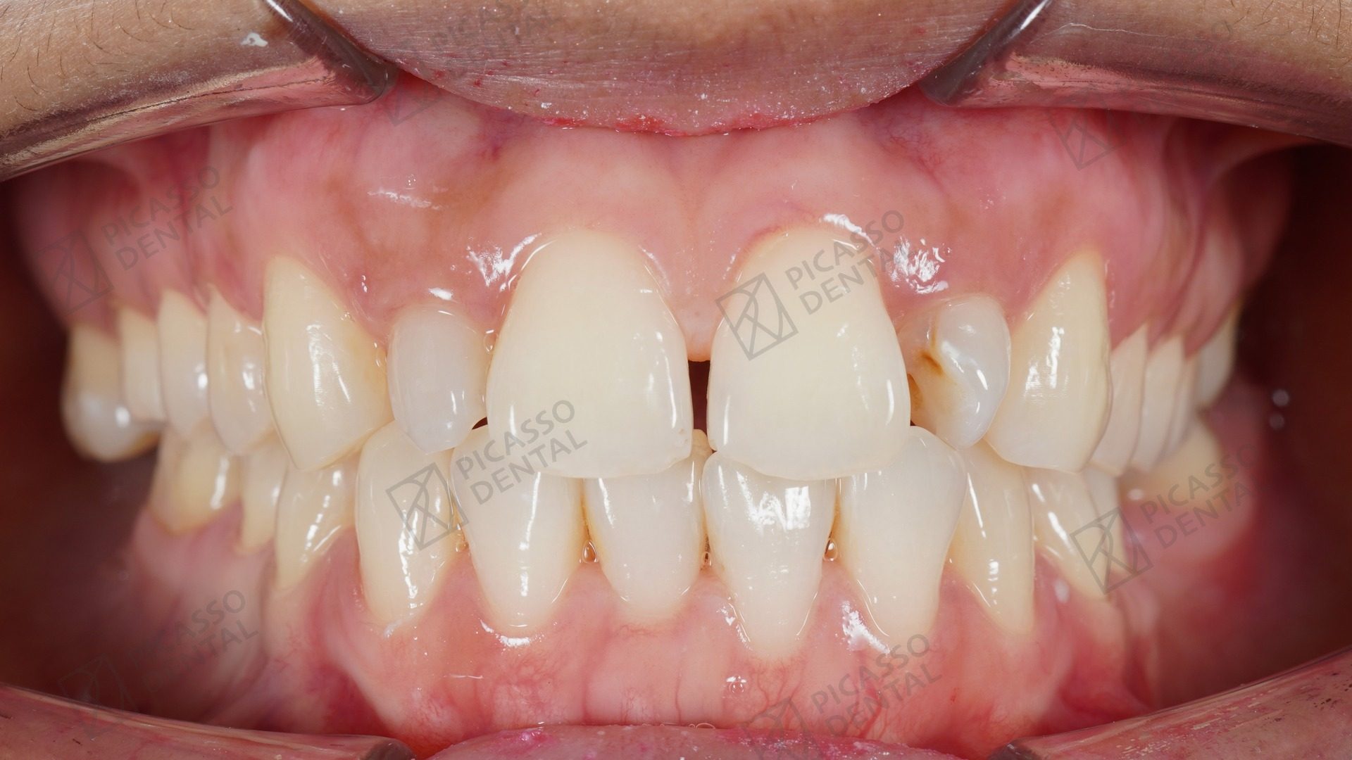 Before: post-orthodontic upper laterals with size discrepancy prior to composite veneer finishing
