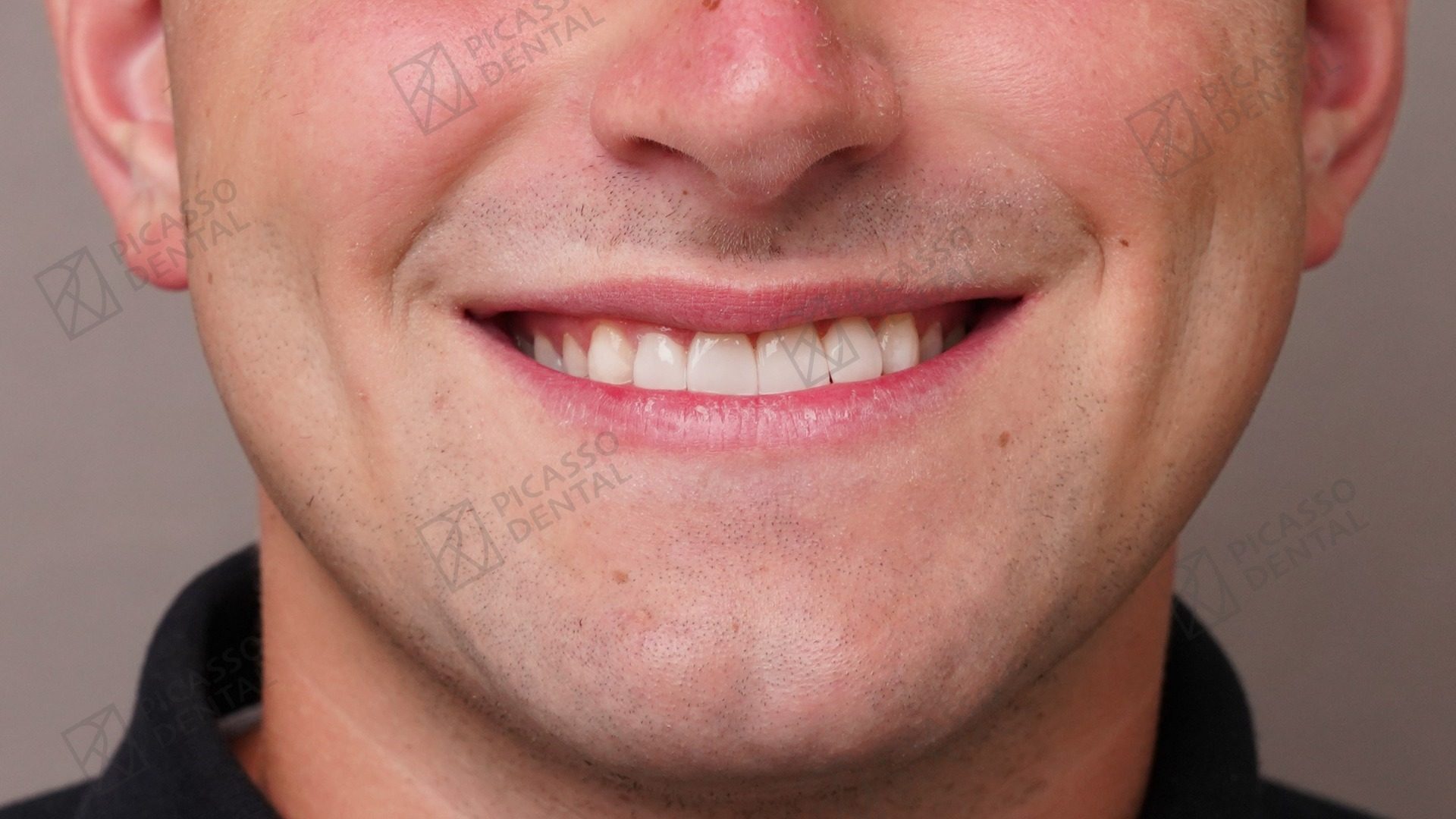 After: 4 composite veneers rebuilding upper central and lateral incisors, Picasso Dental Thao Dien