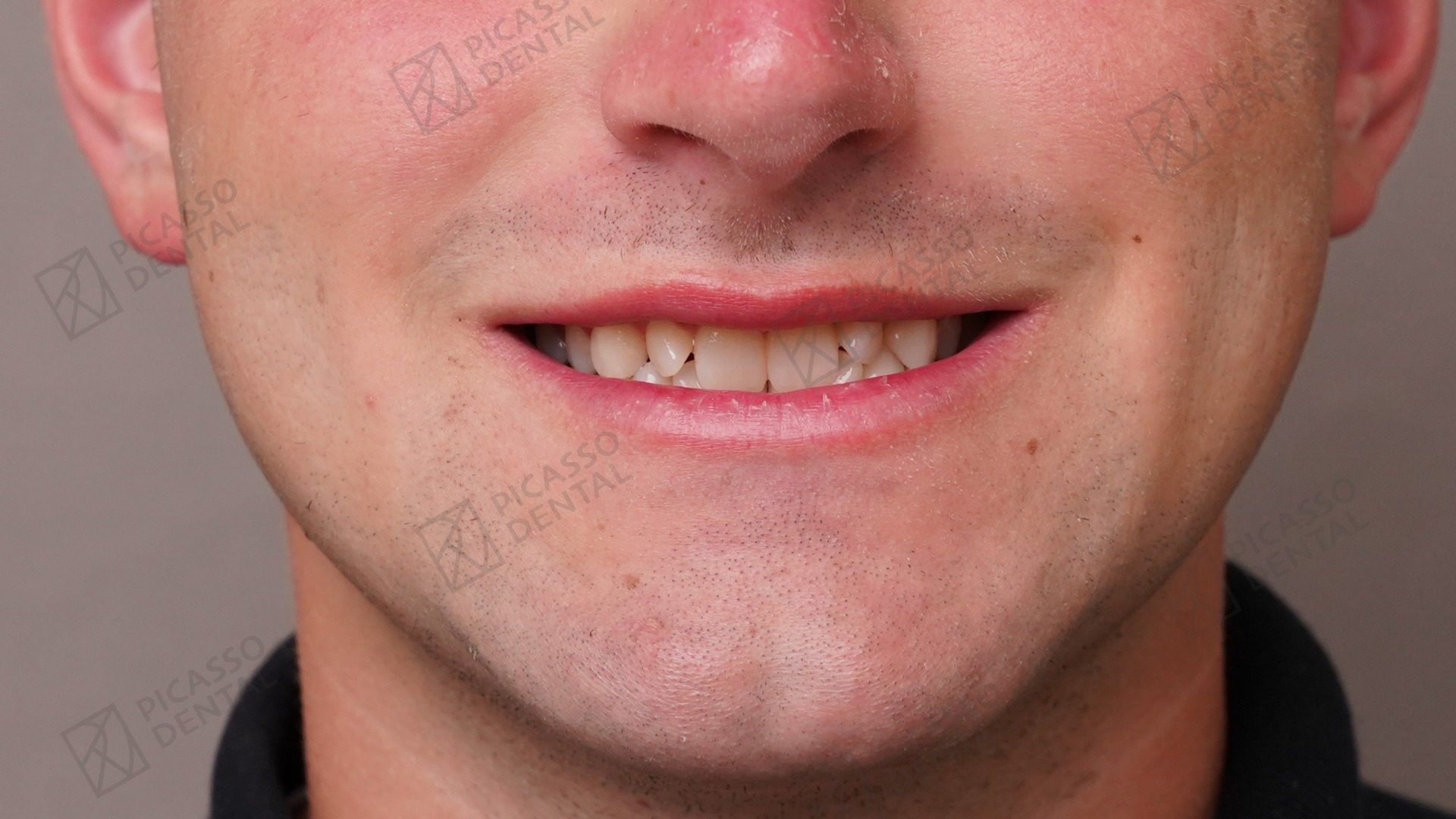 Before: chipped upper central incisors with short clinical crowns and uneven edges prior to composite veneer treatment