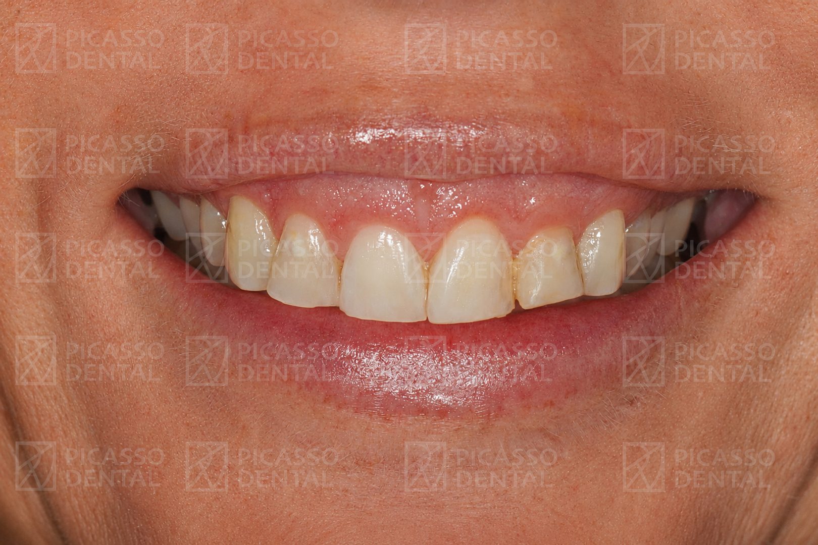 Before: discoloured and uneven upper teeth prior to veneer treatment