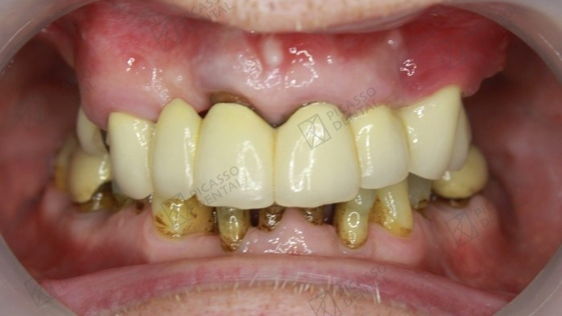 Before All-on-4 treatment
