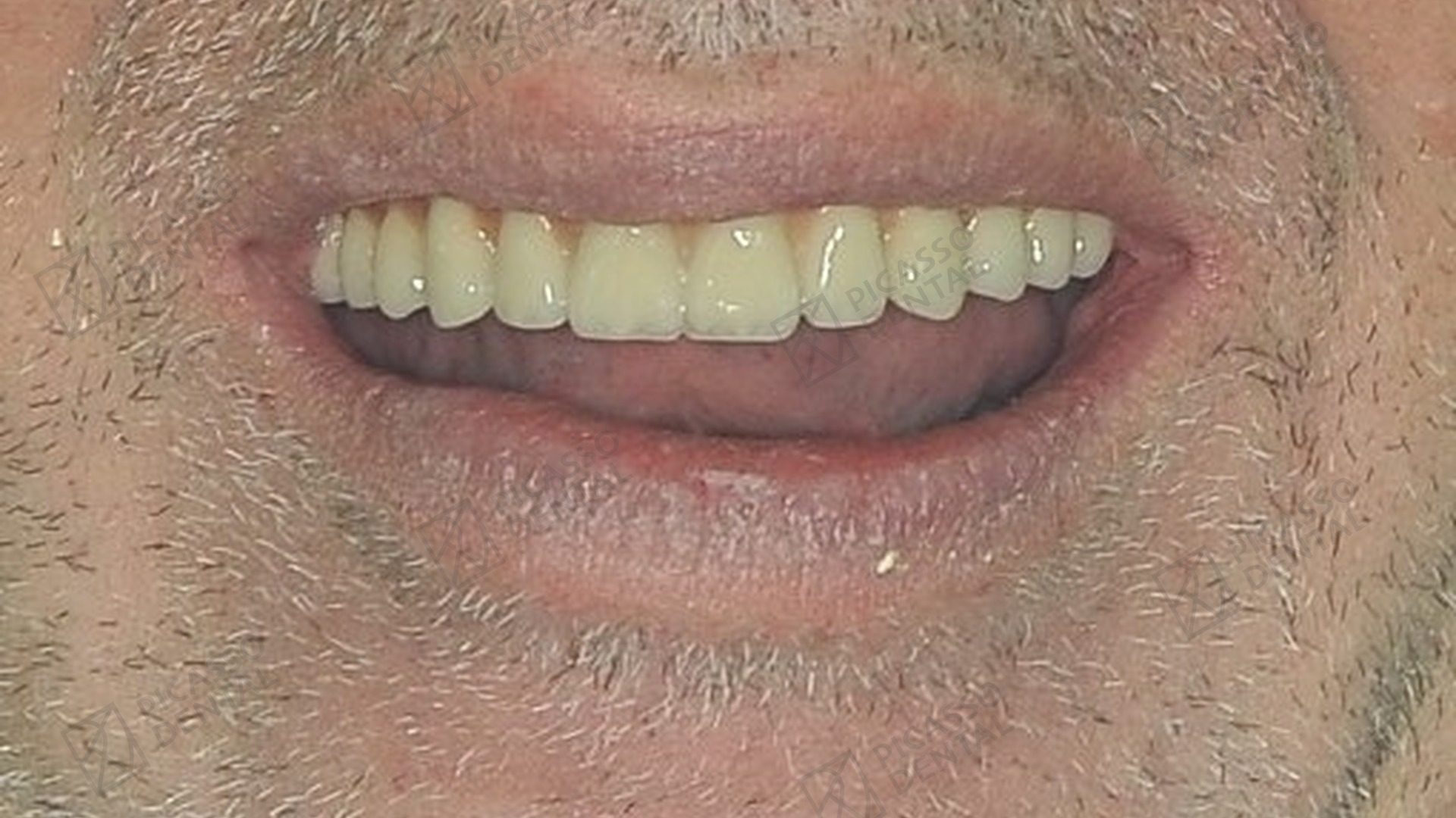 After All-on-4 treatment
