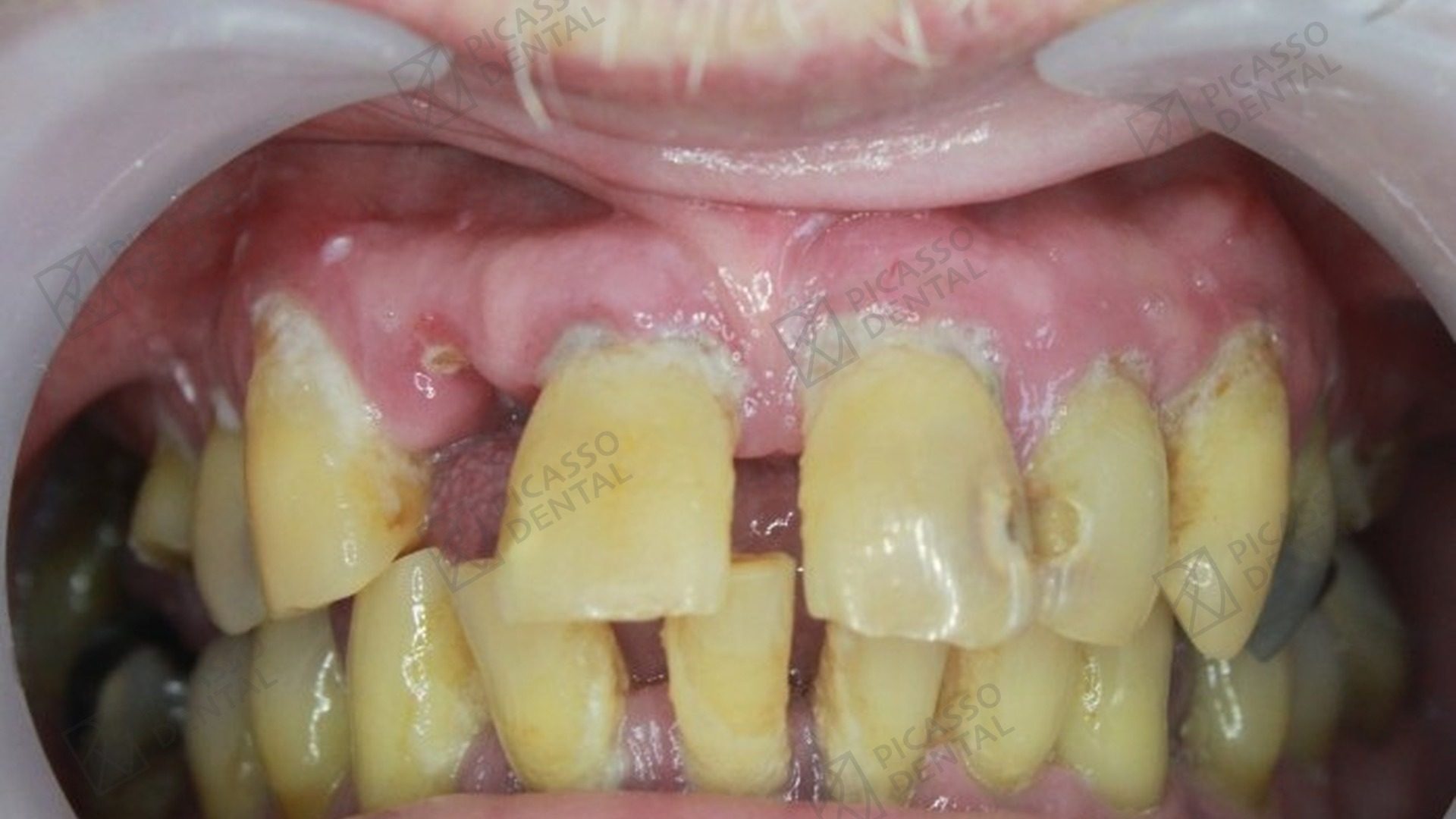 Before All-on-4 treatment
