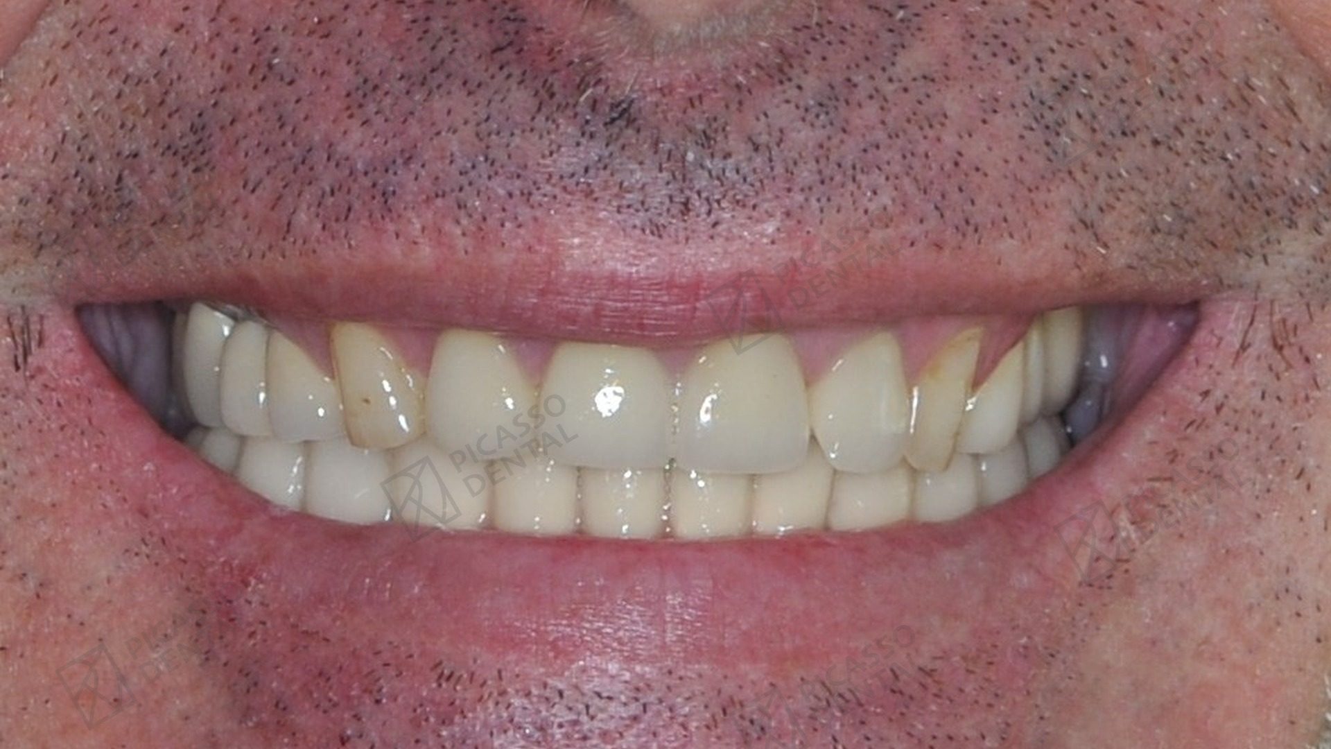 After: natural-looking full smile restored with Nobel Biocare All-on-4 plus additional single implants, Picasso Dental Old Quarter Hanoi