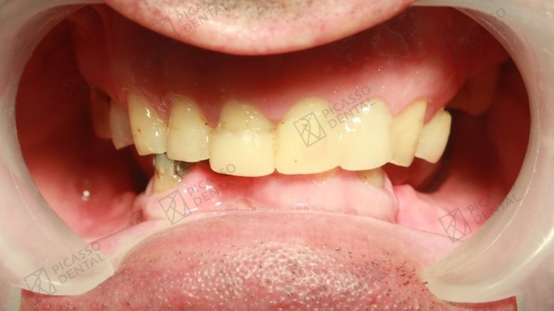 Before: heavily worn and discolored upper teeth in a 50s male patient prior to All-on-4 plus additional implant surgery at Picasso Dental
