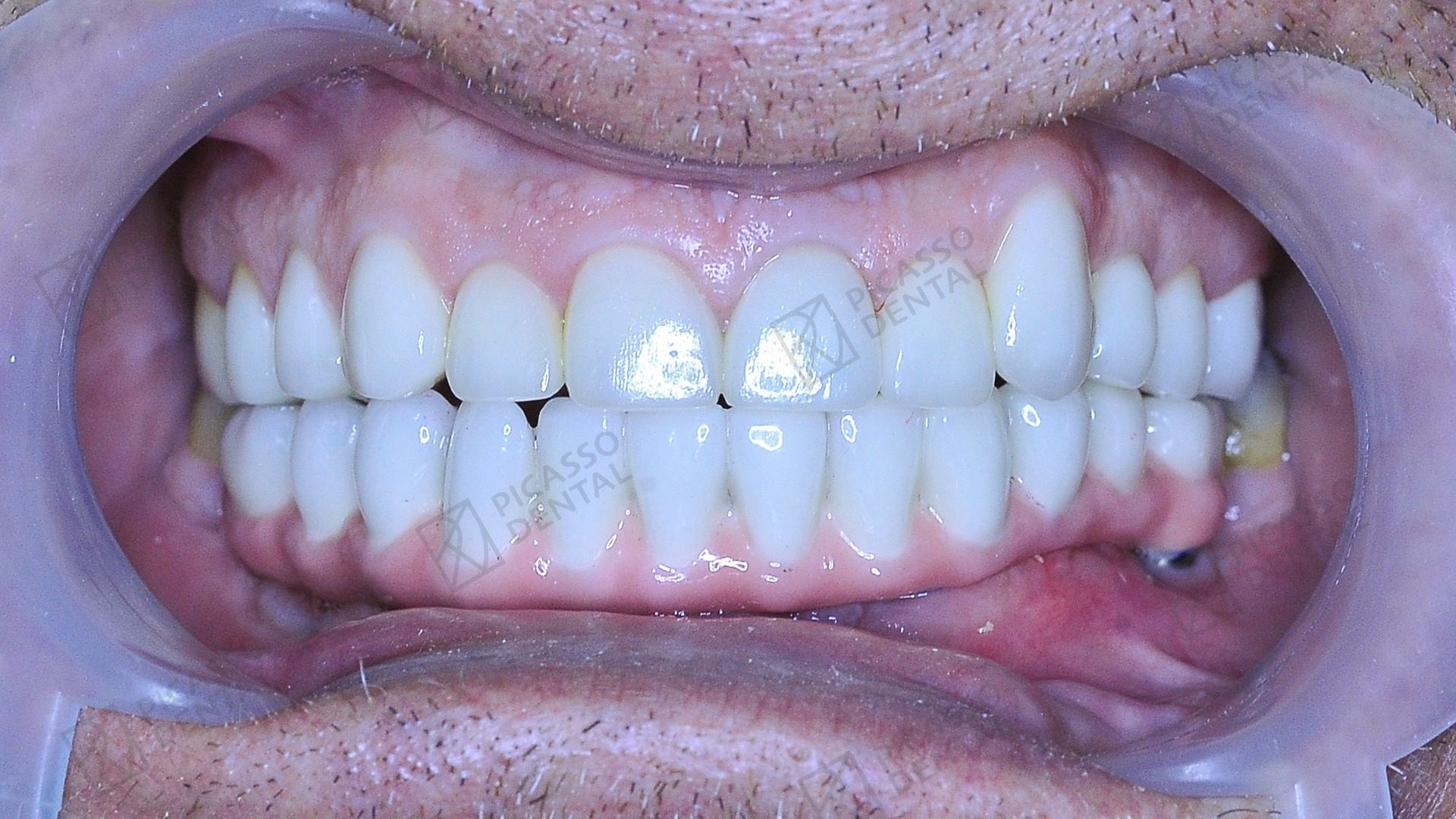 After All-on-4 treatment