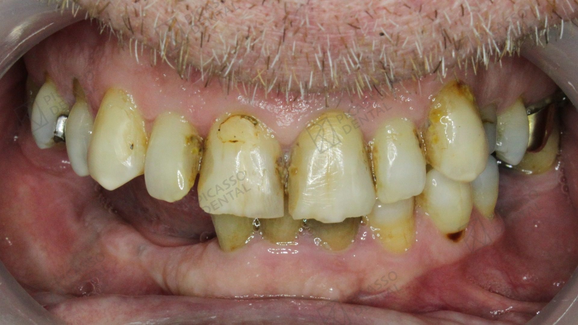 Before All-on-4 treatment
