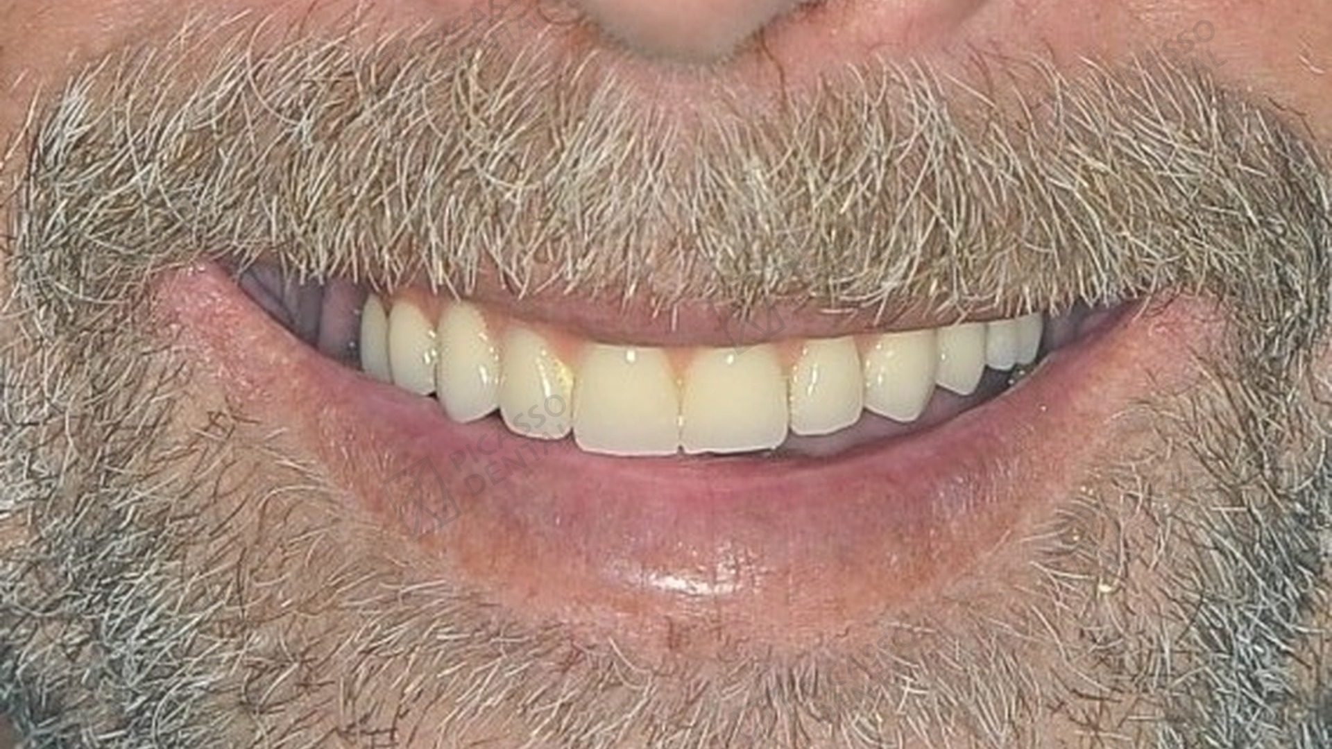 After: full natural smile restored with Nobel Biocare All-on-4 upper jaw bridge, Picasso Dental Old Quarter Hanoi