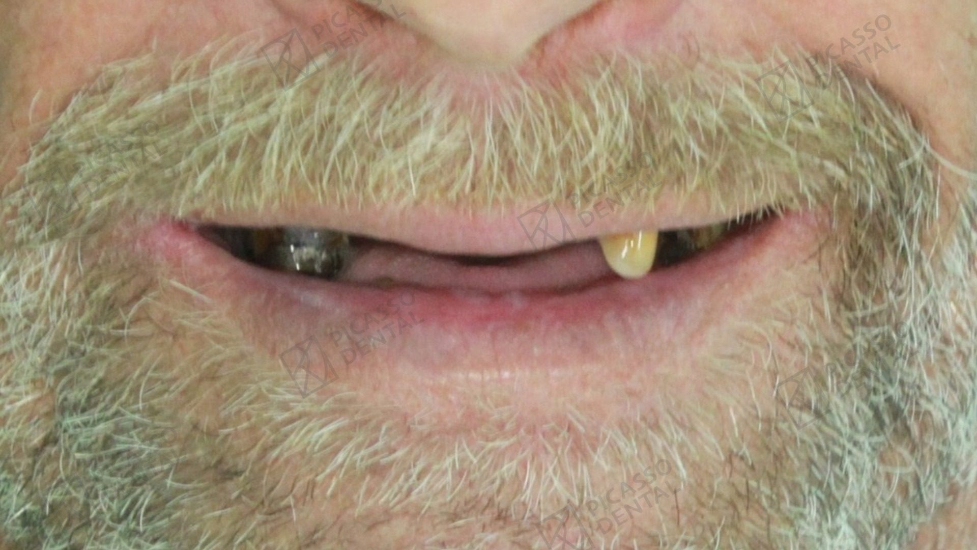 Before: edentulous upper jaw with only two remaining lower teeth in a 60s male patient prior to All-on-4 placement at Picasso Dental