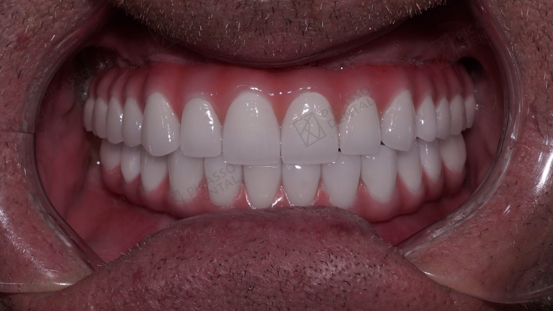 After: bright white full-arch zirconia bridge on five Nobel Biocare implants, Picasso Dental Thao Dien HCMC
