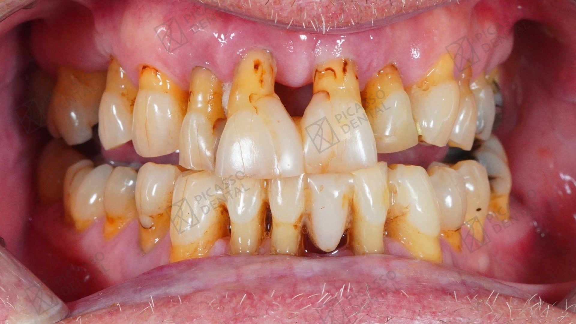 Before: severe staining, heavy calculus and gum disease across the full mouth in a 60s male patient prior to All-on-5 full-arch rehabilitation at Picasso Dental