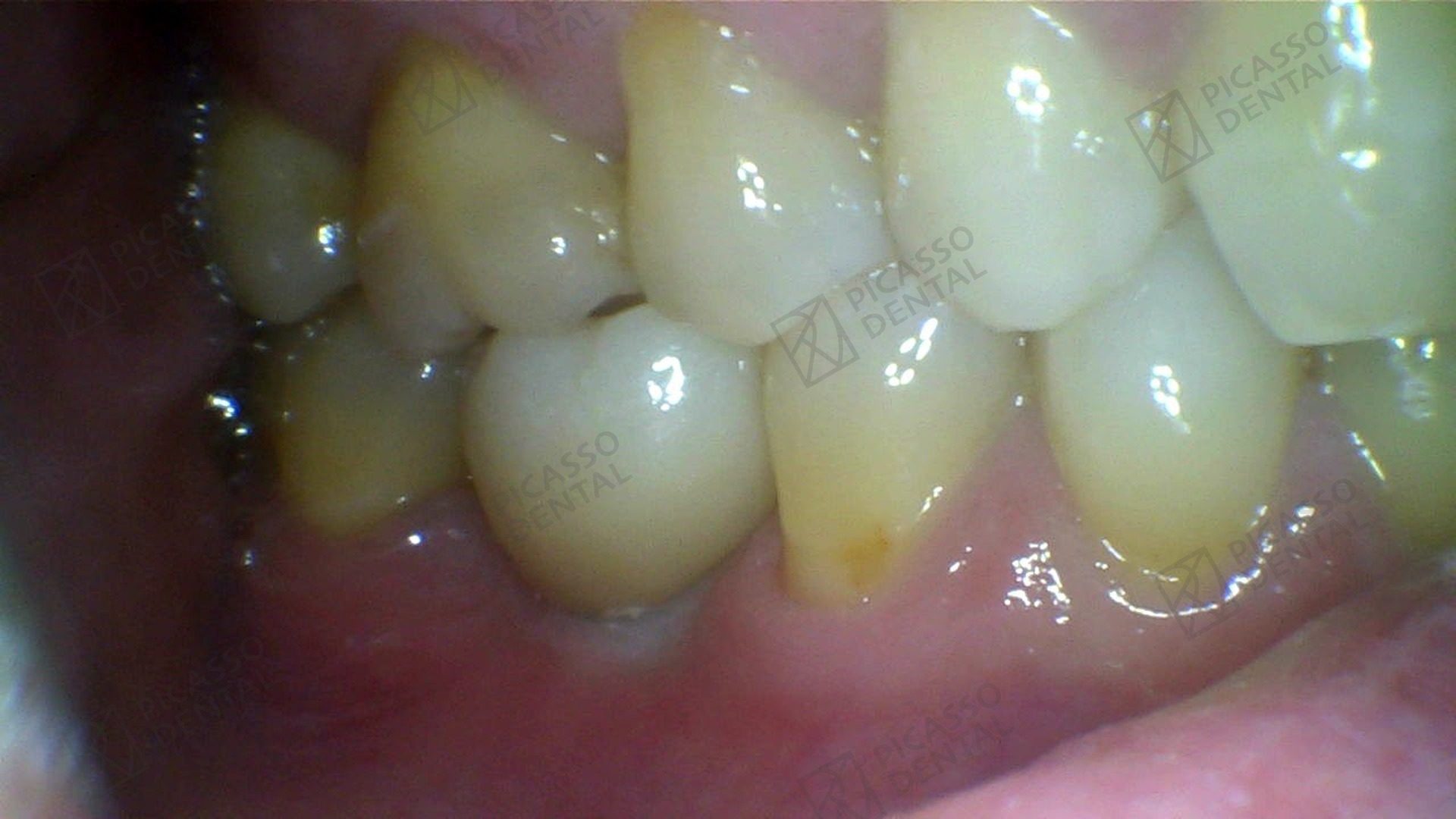After: single ETK implant with zirconia crown restoring lower right first molar (tooth 46), Picasso Dental Old Quarter Hanoi