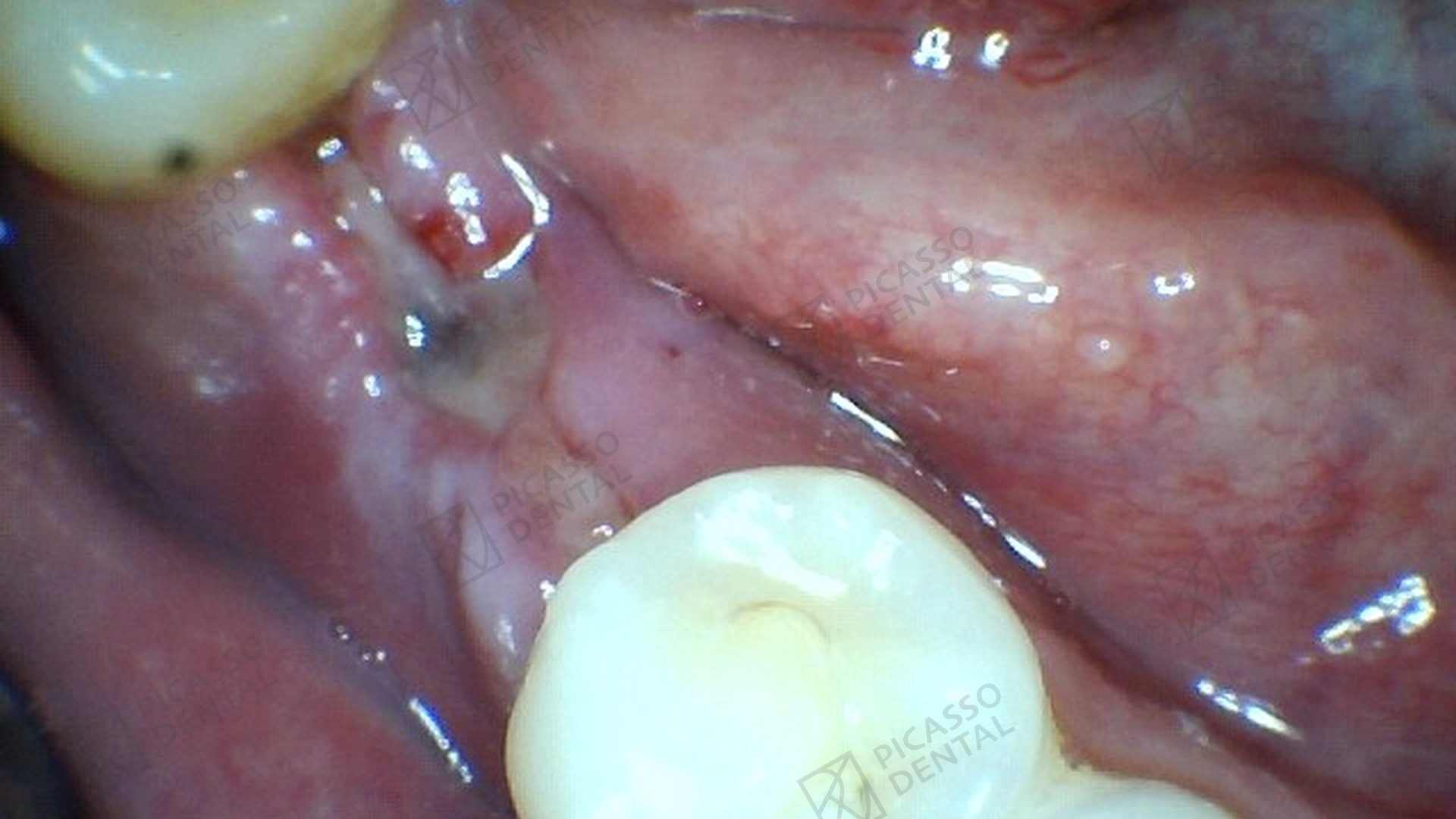 Before: missing lower right first molar (tooth 46) with empty socket prior to single implant placement at Picasso Dental