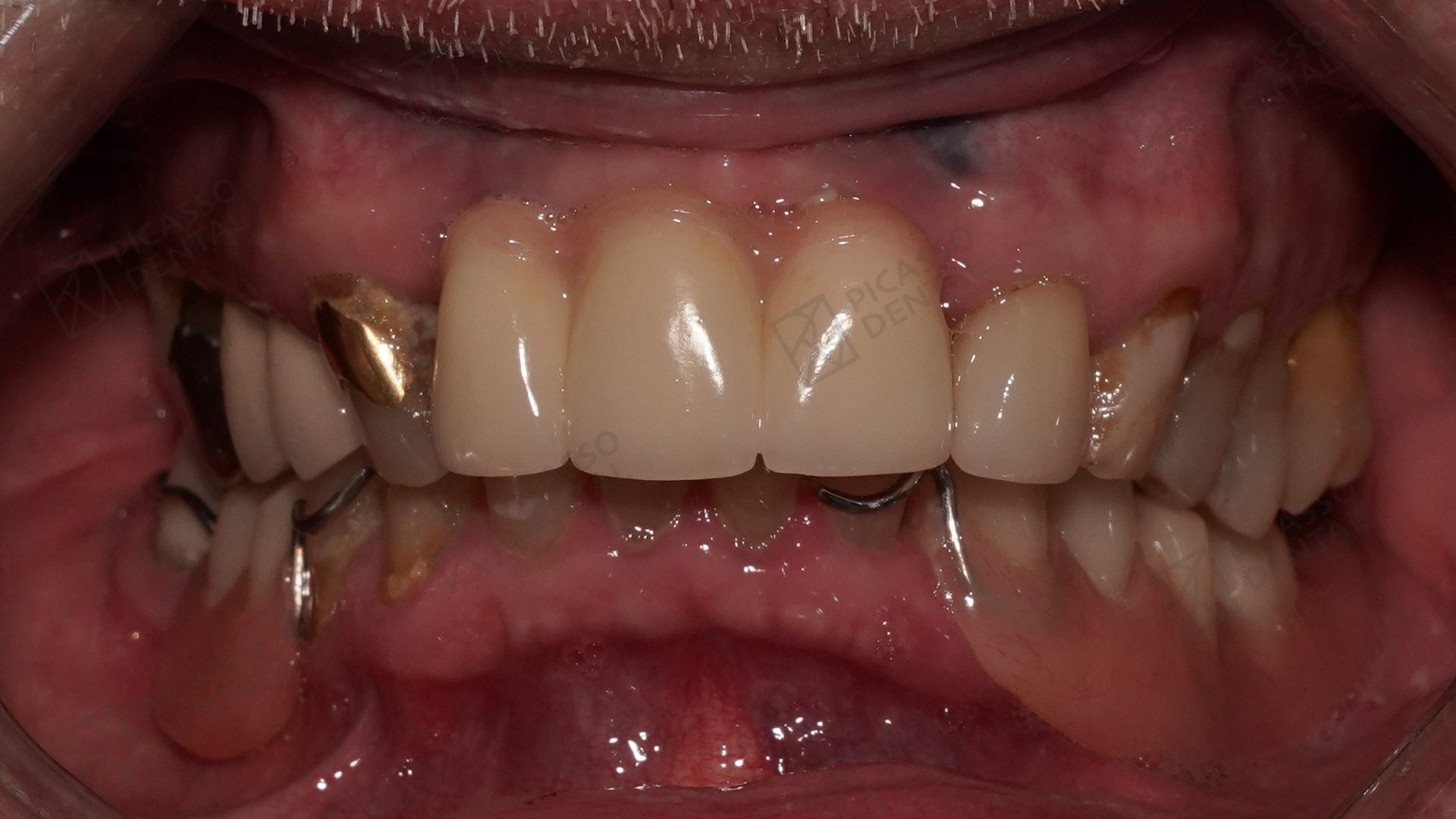 Before All-on-4 treatment