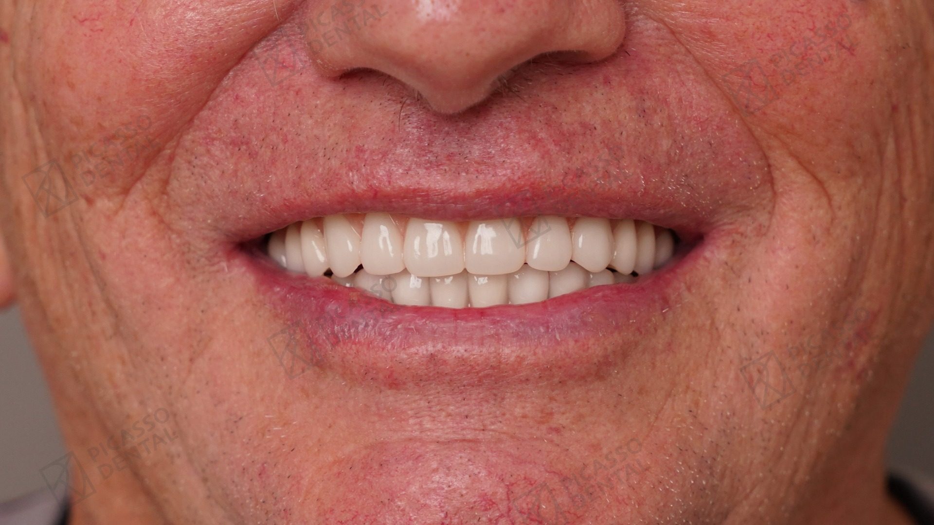 After full-arch implant treatment