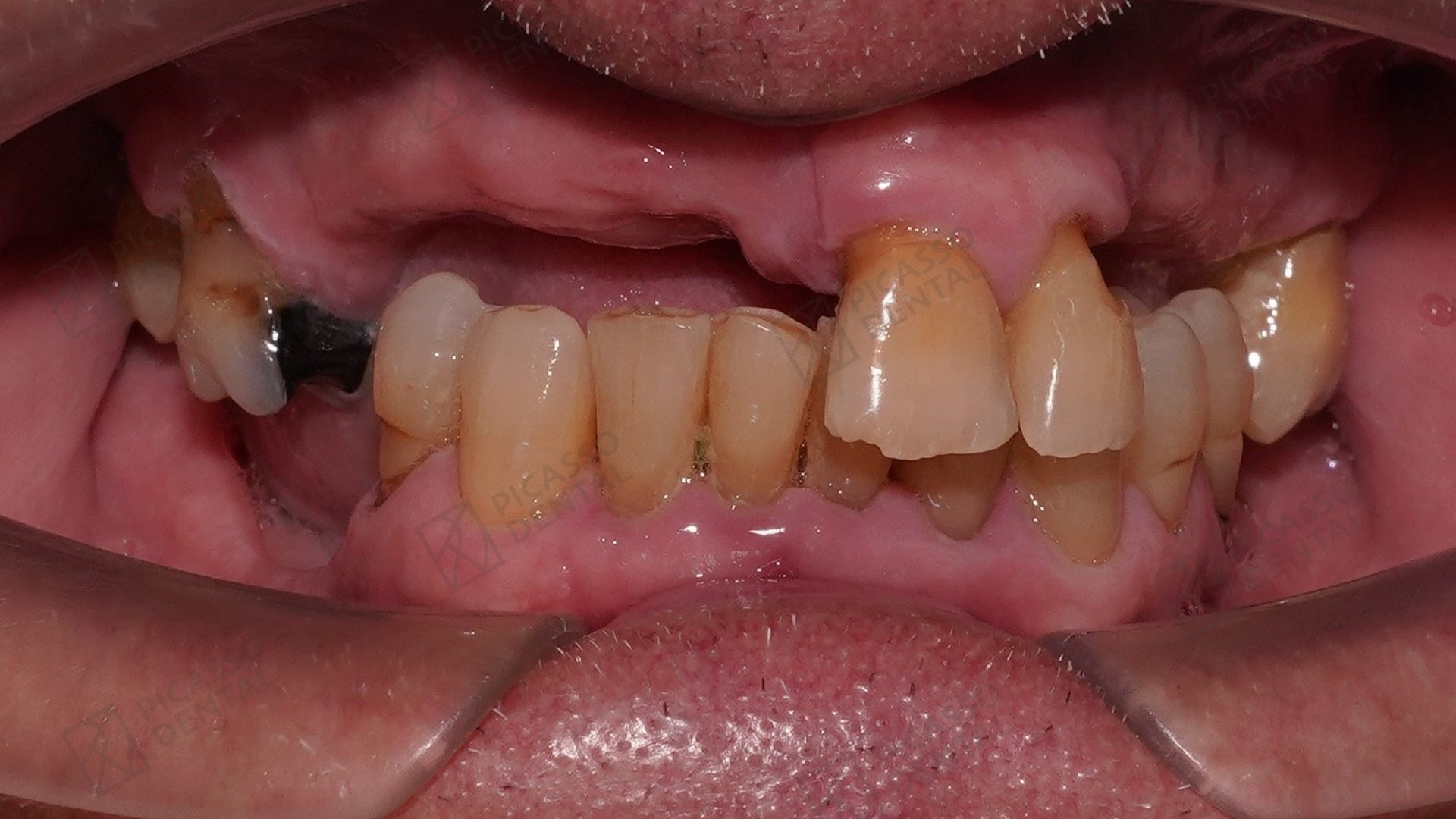 Before full-arch implant treatment