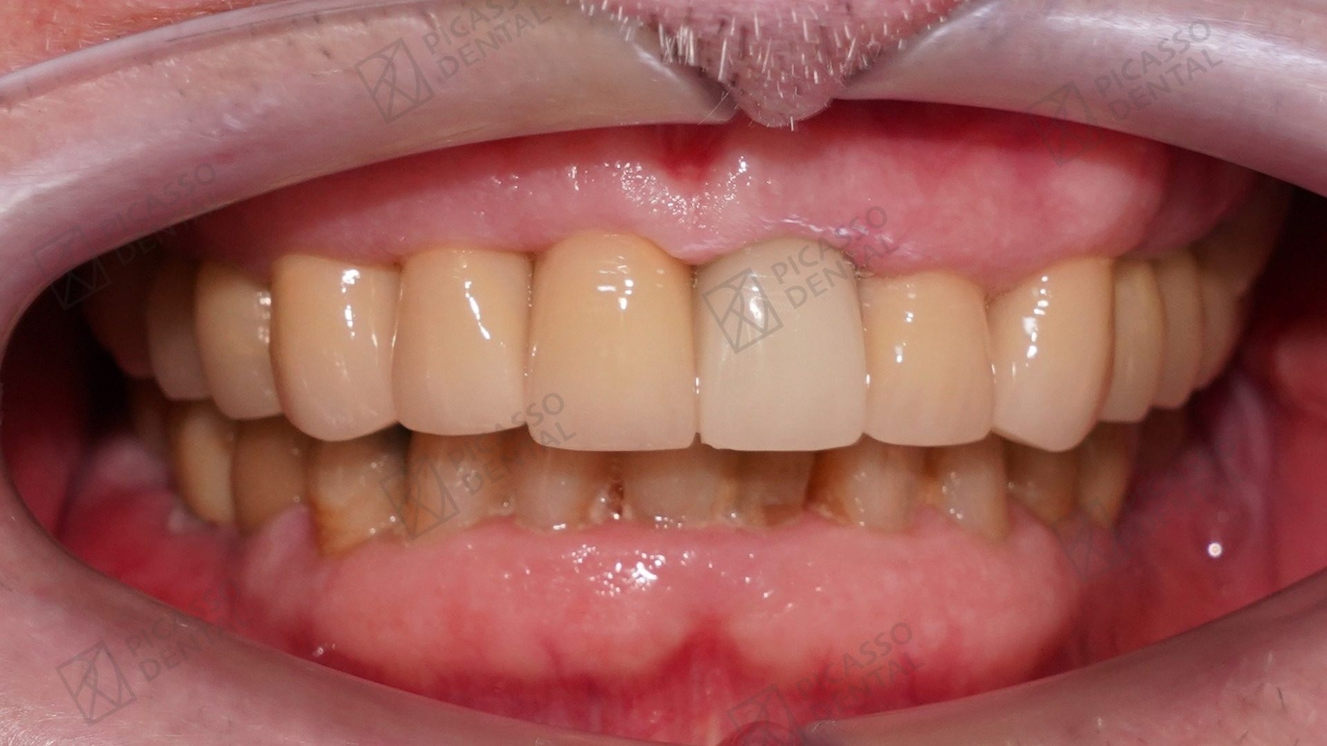After: ETK and Osstem single implants with zirconia crowns and bridge across the upper arch, Picasso Dental Thao Dien HCMC