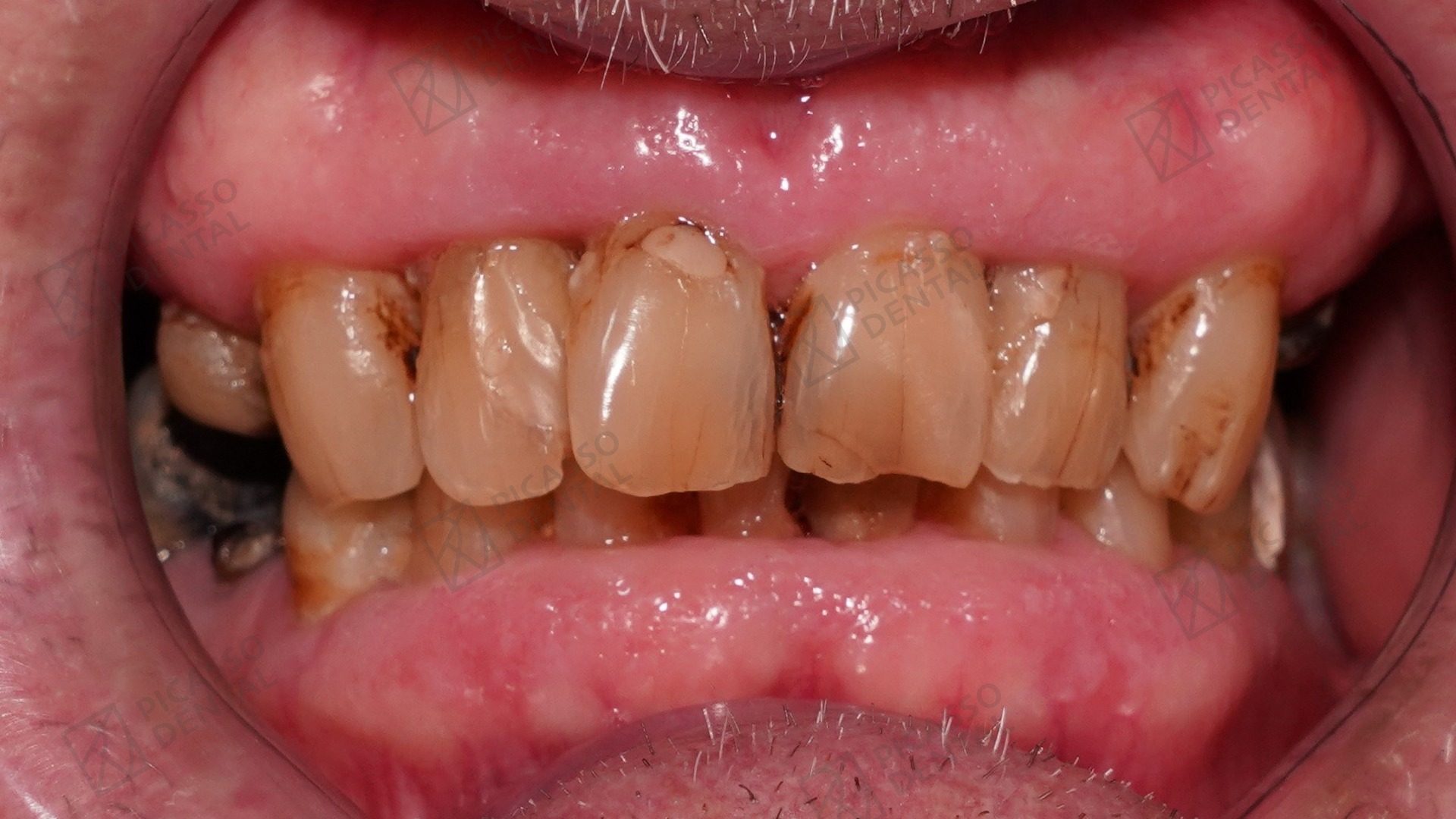 Before: severely worn and discoloured upper teeth with heavy staining in a 70s patient prior to implant and full-arch zirconia restoration