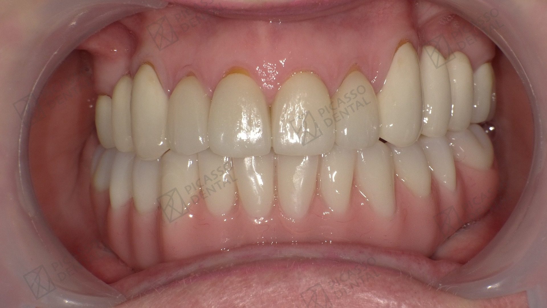 After: clean, even full-arch Nobel Biocare All-on-4 upper jaw bridge meeting the natural lower dentition, Picasso Dental Thao Dien HCMC