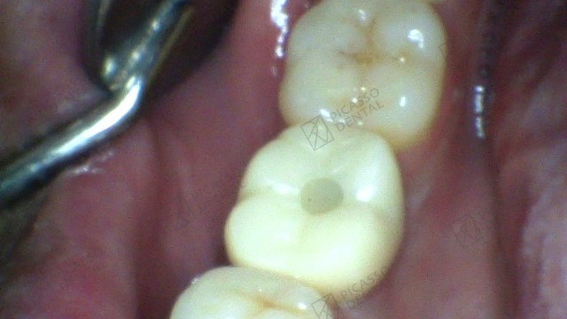After: single ETK implant with custom titanium abutment and zirconia crown on upper right molar (tooth 16), Picasso Dental Da Nang