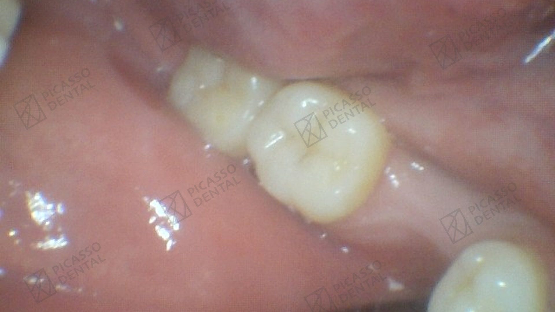 Before: missing upper right first molar with extracted tooth root tip prior to single implant placement at Picasso Dental
