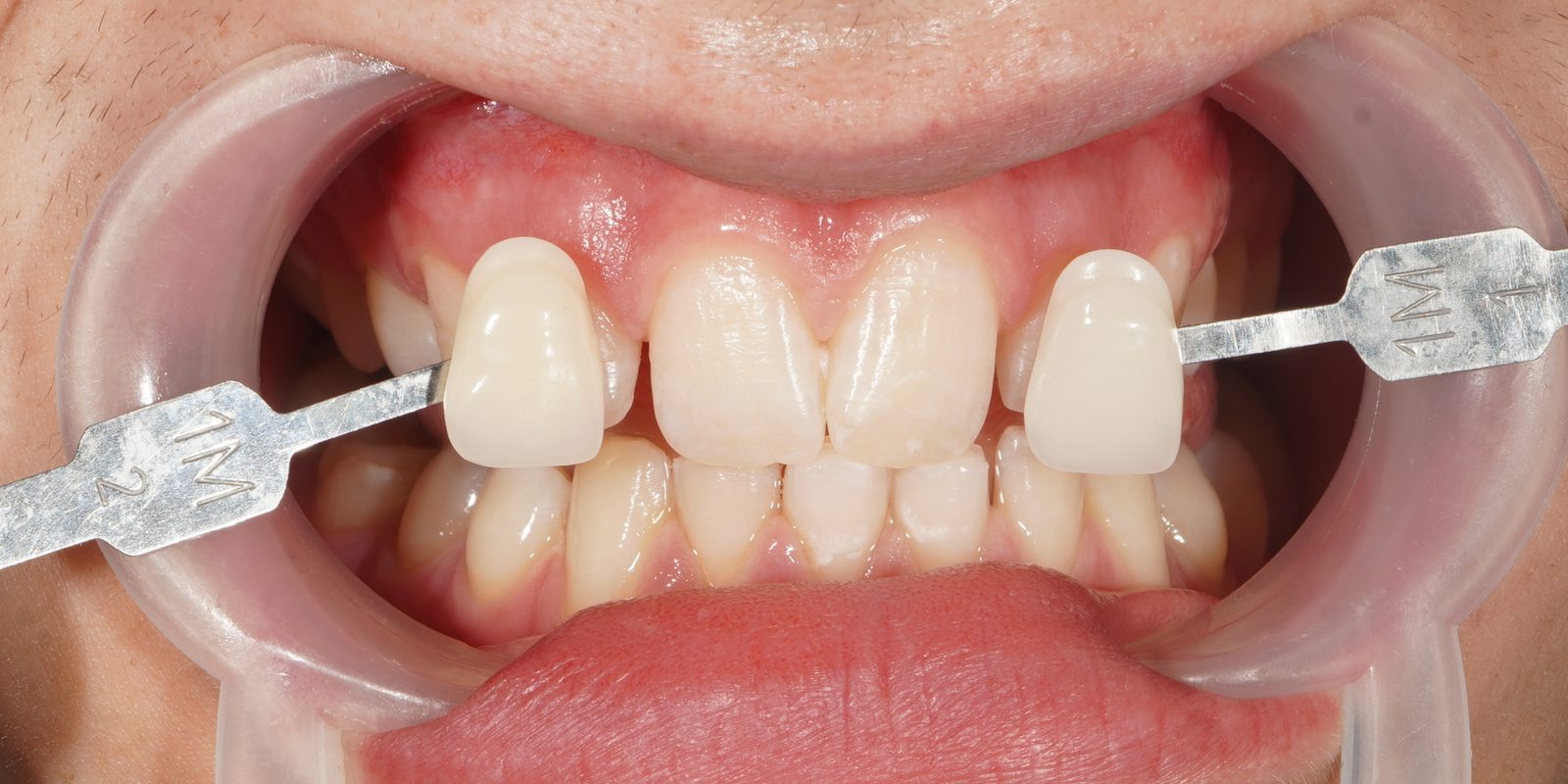 After: noticeably whiter teeth following Picasso Glow laser whitening, Picasso Dental