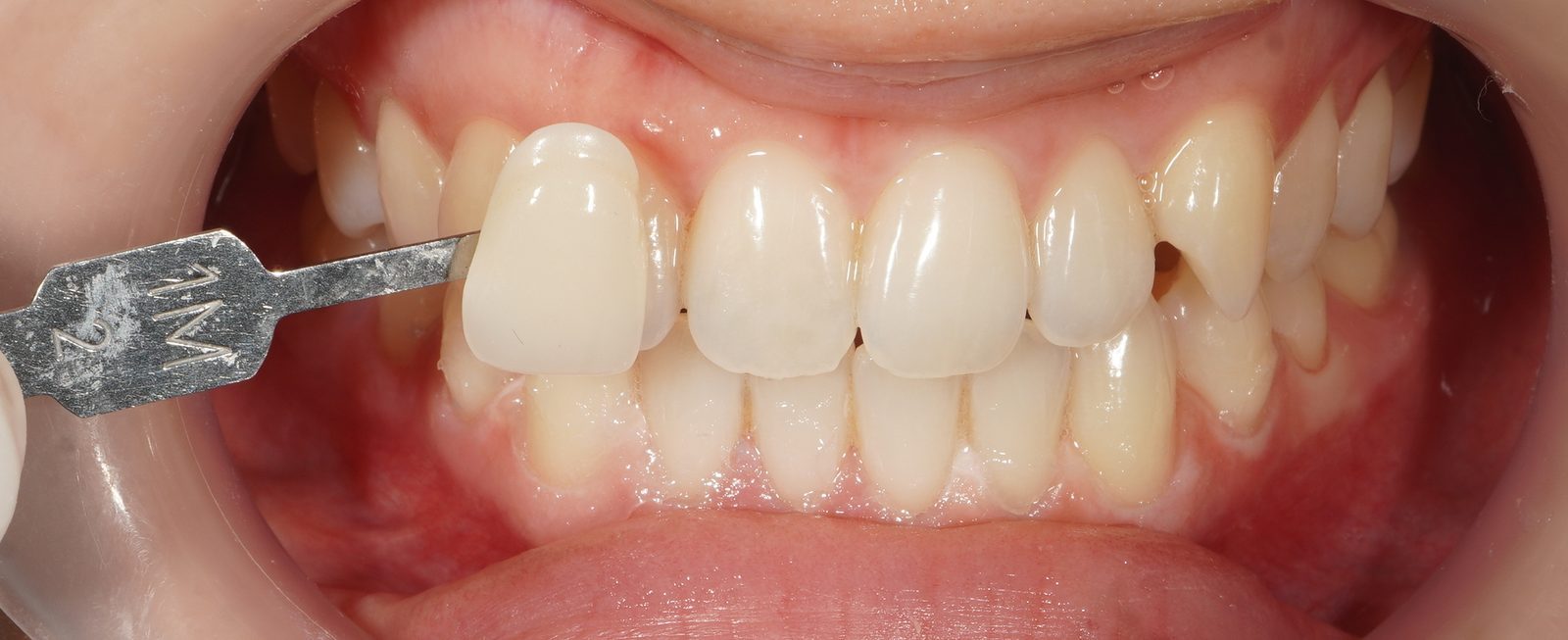 After: significantly whiter teeth following Picasso Glow laser whitening, Picasso Dental