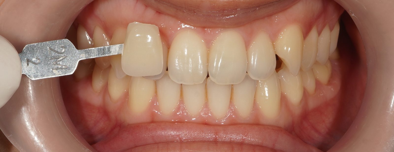 Before: stained teeth prior to Picasso Glow laser whitening at Picasso Dental