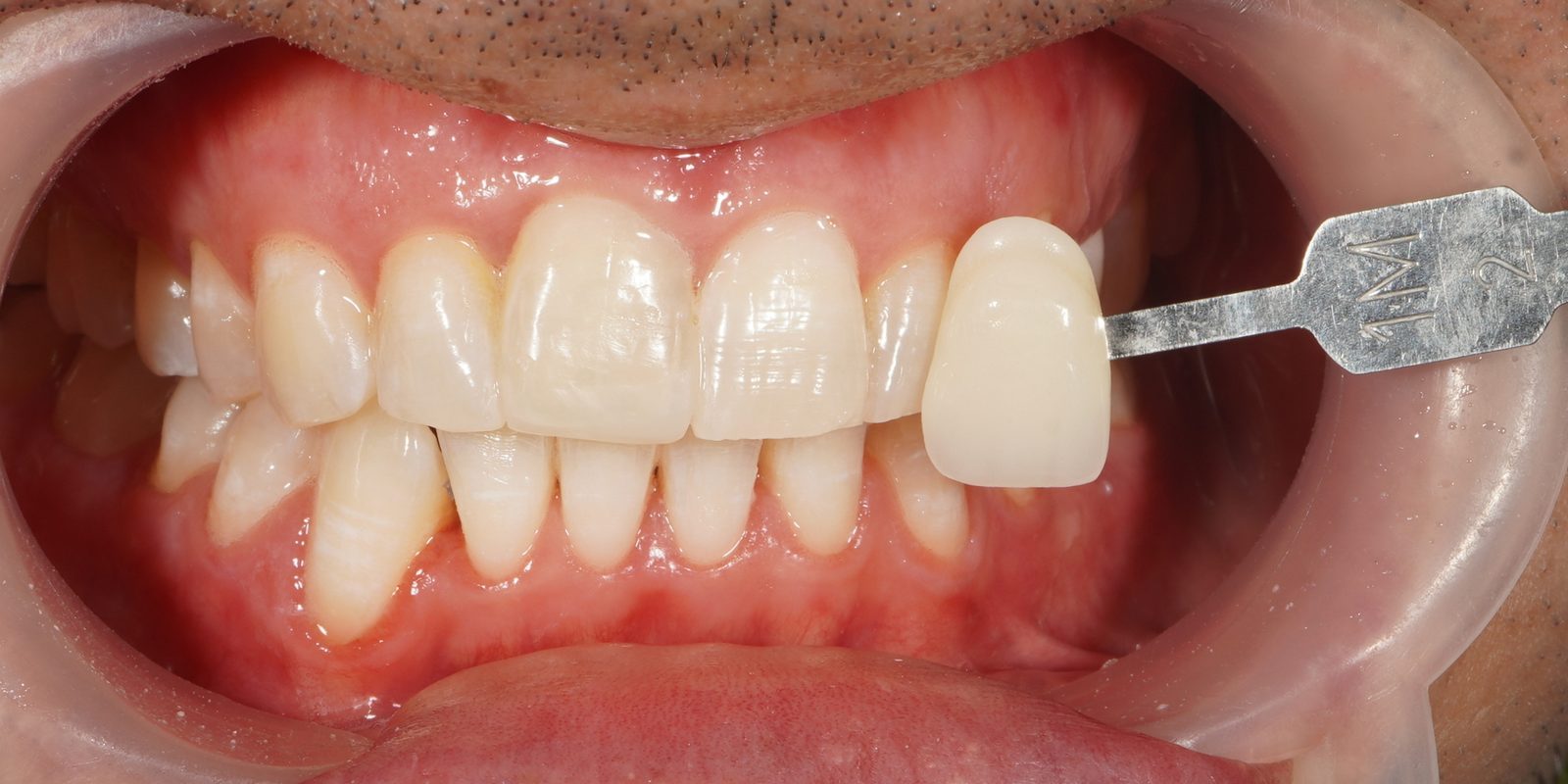 After: brighter teeth following Picasso Glow laser whitening, Picasso Dental