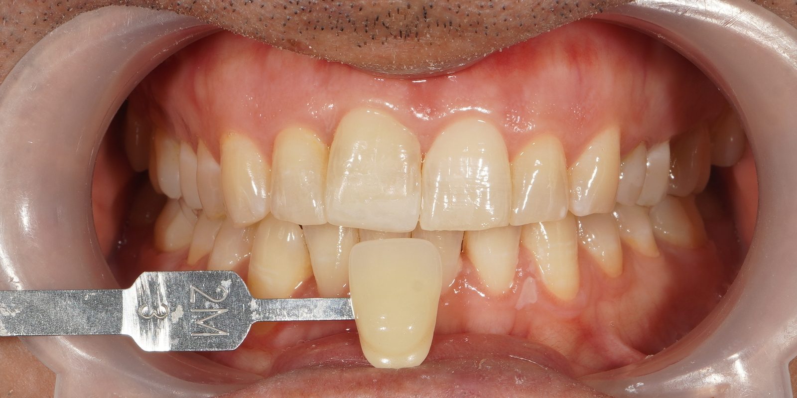 Before: discoloured teeth prior to Picasso Glow laser whitening at Picasso Dental