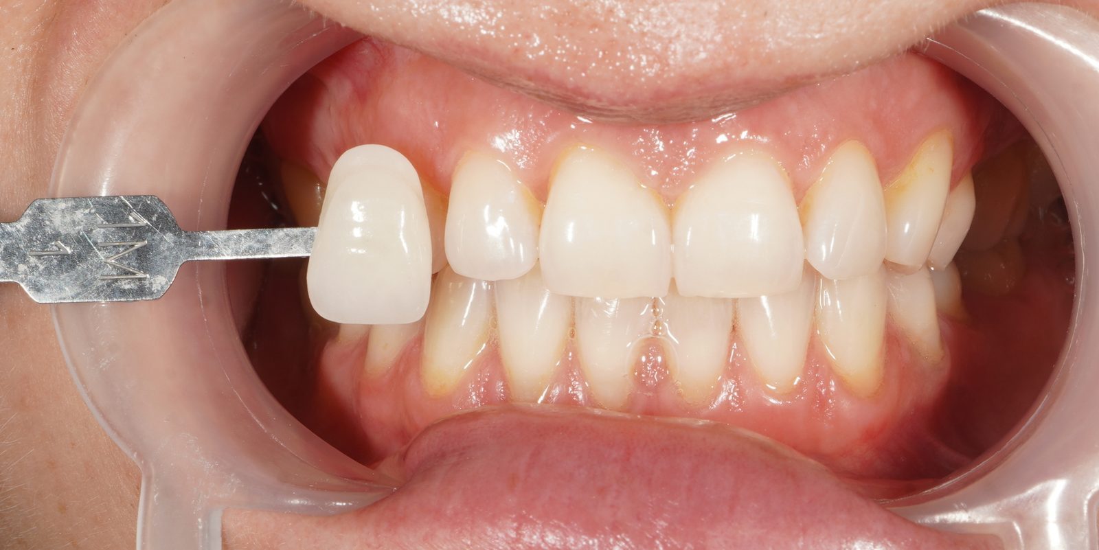 After: visibly whiter teeth following Picasso Glow laser whitening, Picasso Dental